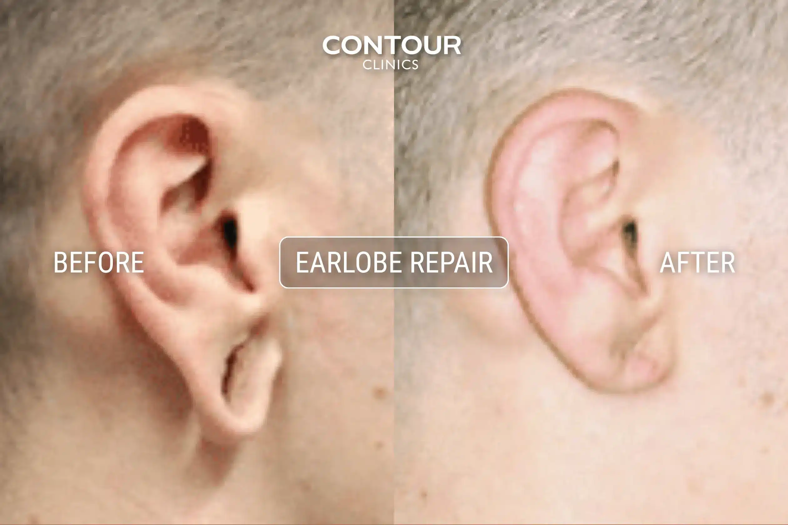 Before and after earlobe repair surgery for gauged lobes at Contour Clinics