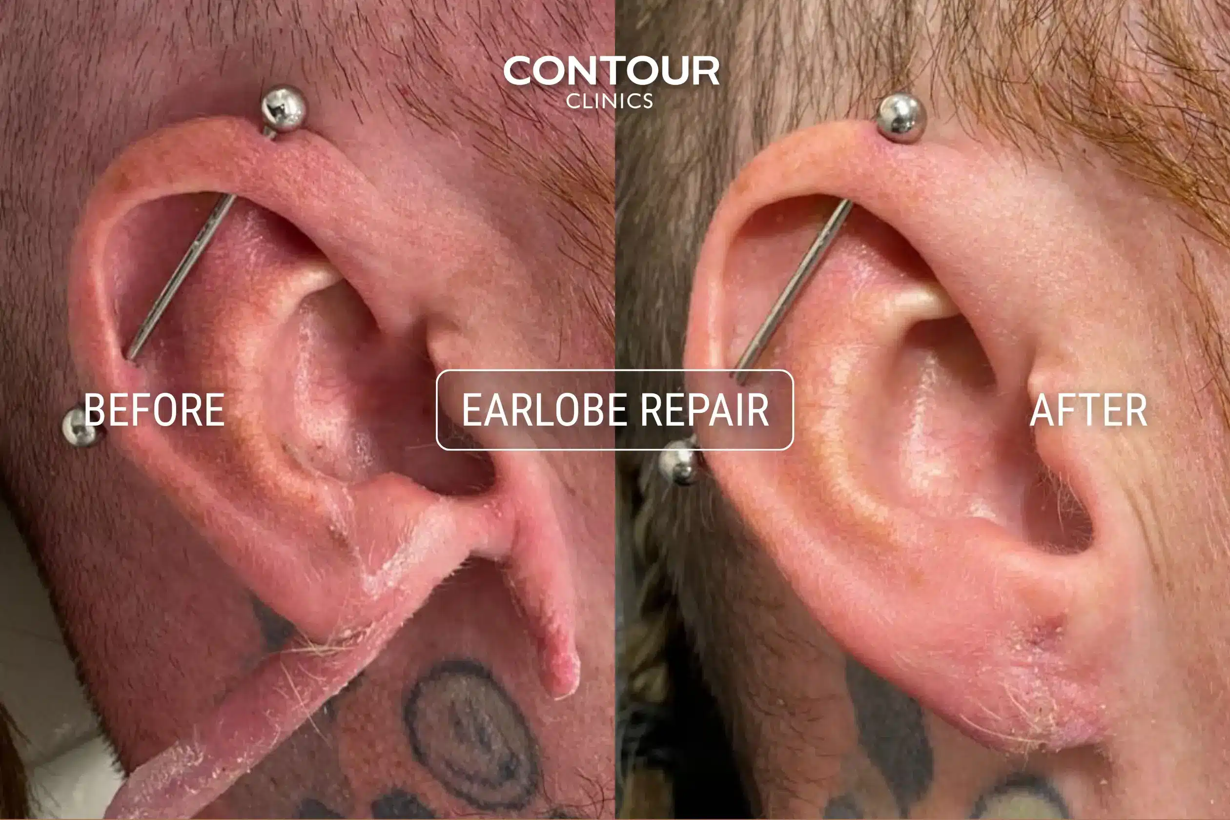 Completely torn earlobe repair before and after image at Contour Clinics