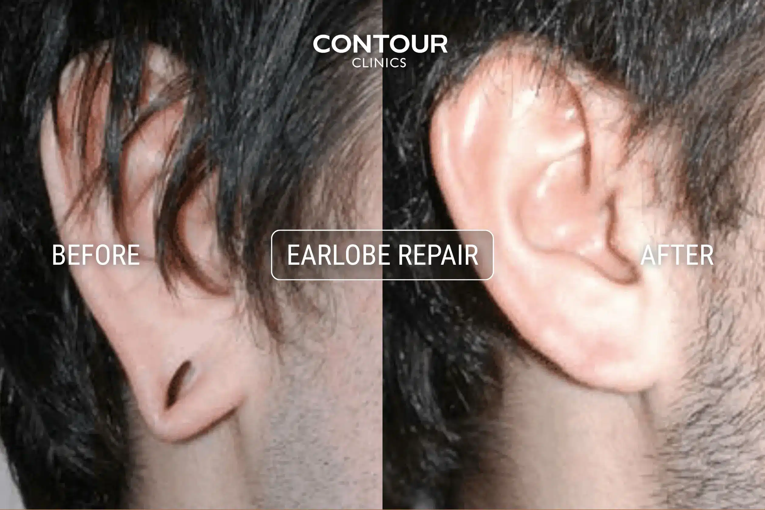 Earlobe surgery for gauged lobe before and after image at Contour Clinics
