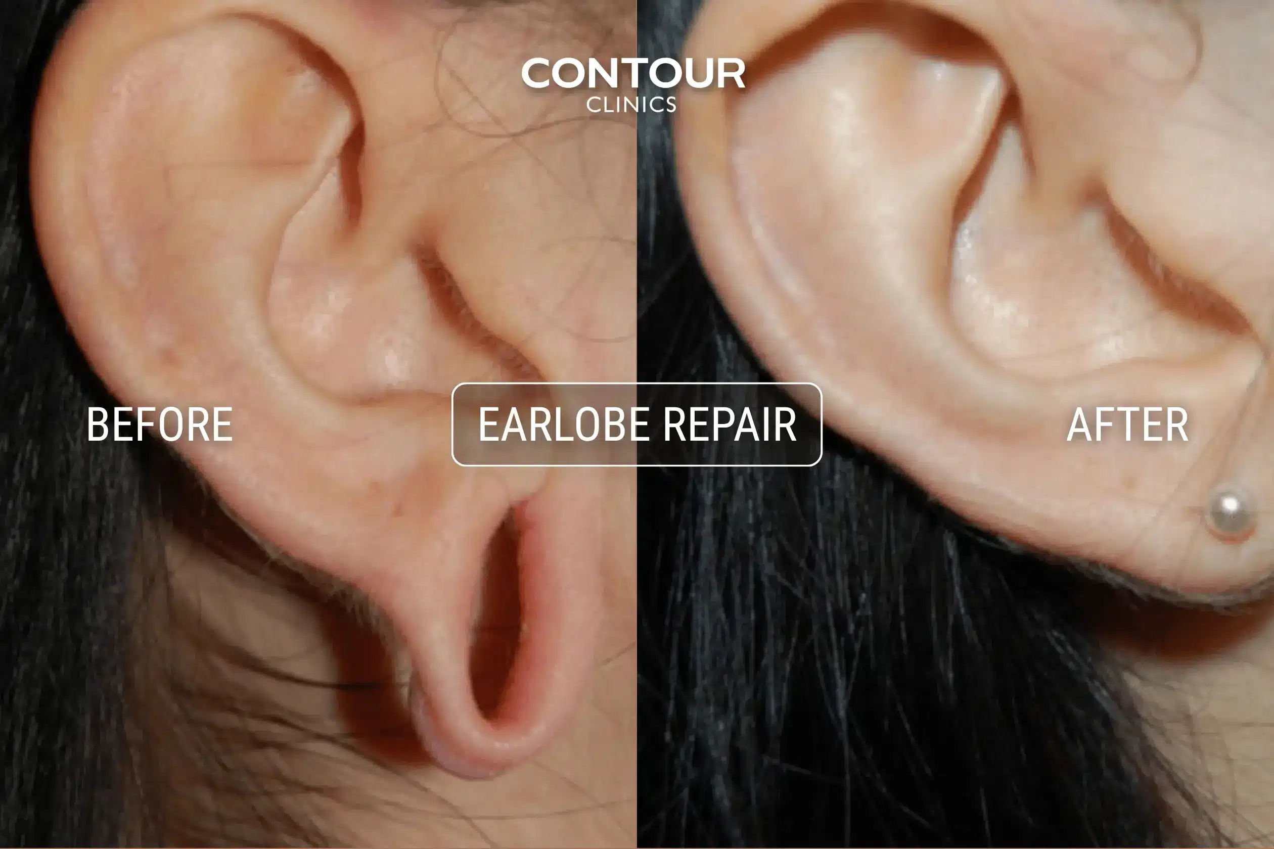 Gauged and stretched earlobe repair before and after image at Contour Clinics