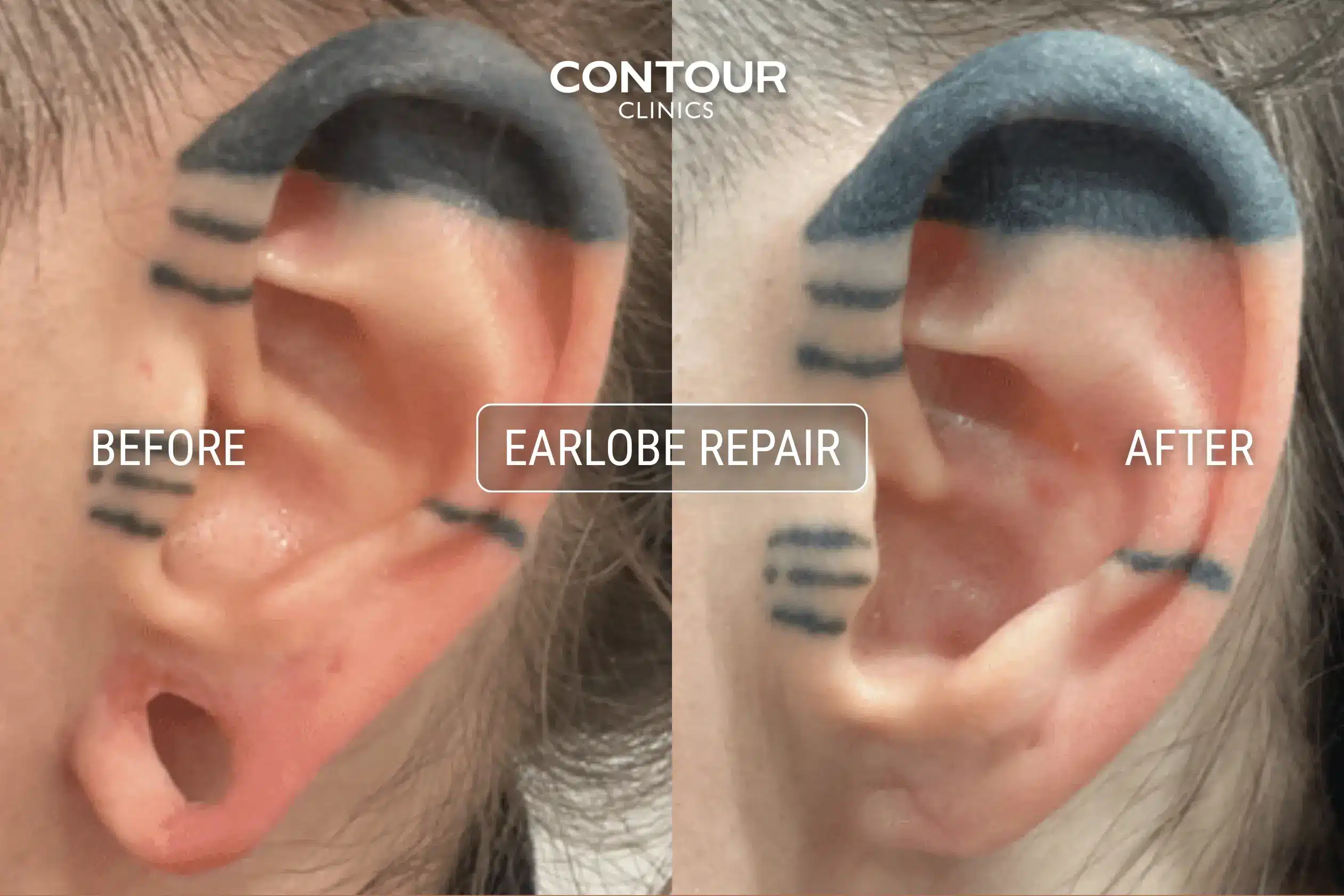 Gauged earlobe repair before and after image at Contour Clinics