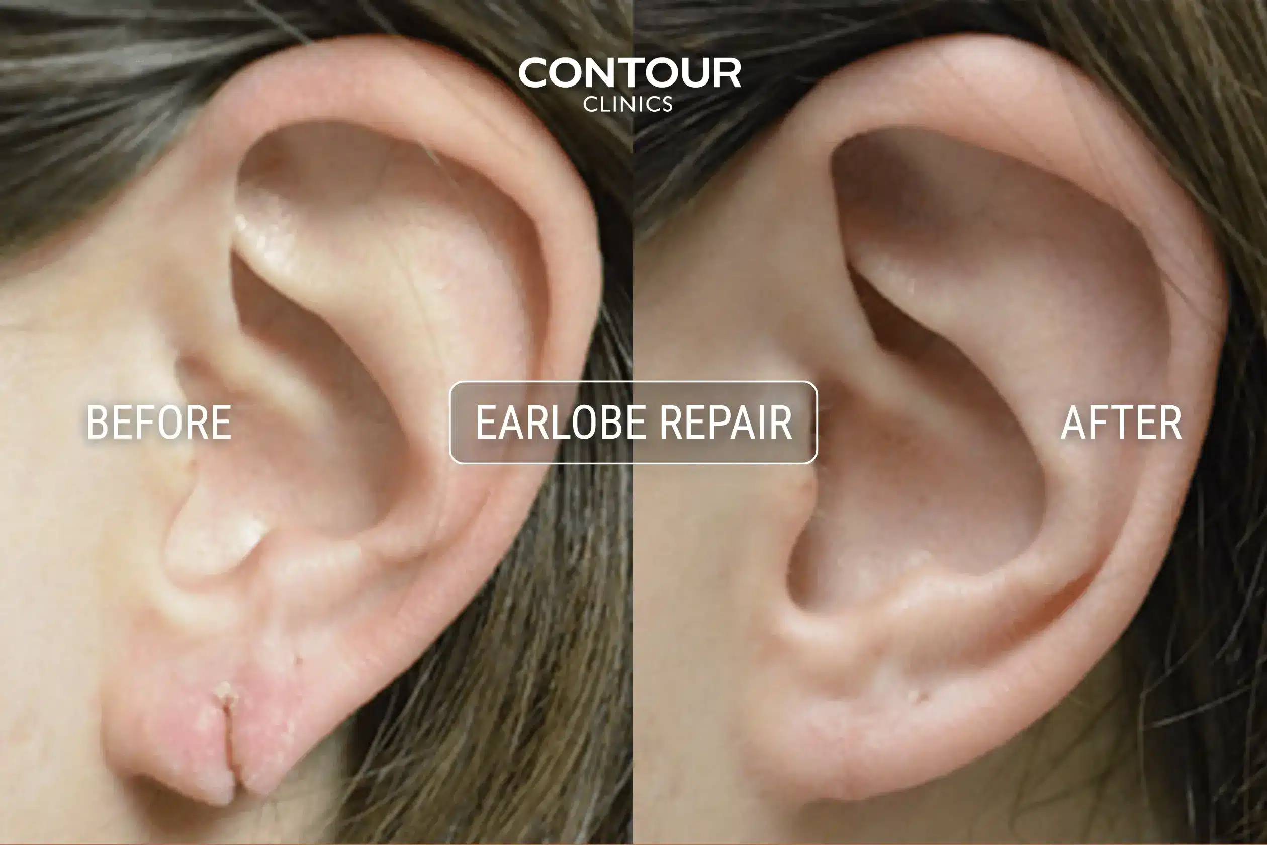 Ripped earlobe repair before and after image at Contour Clinics