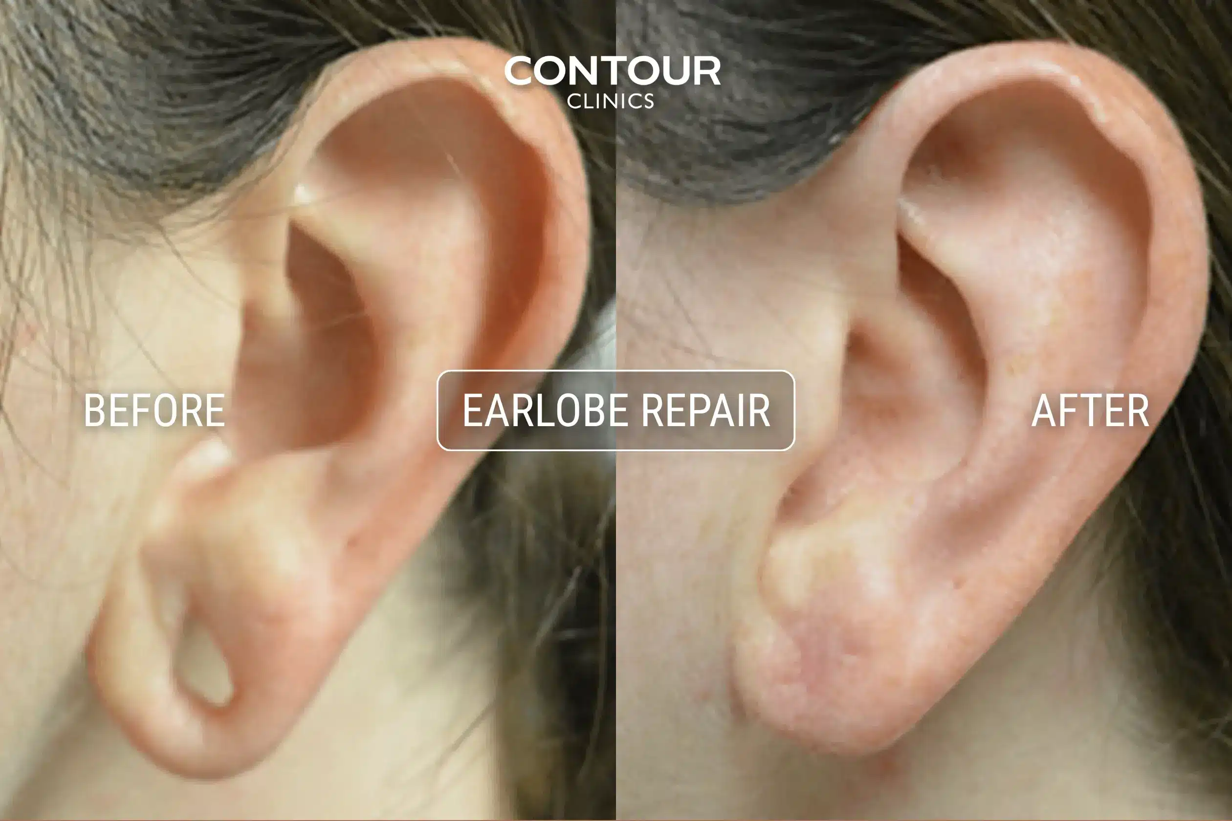 Gauged earlobe repair before and after image at Contour Clinics