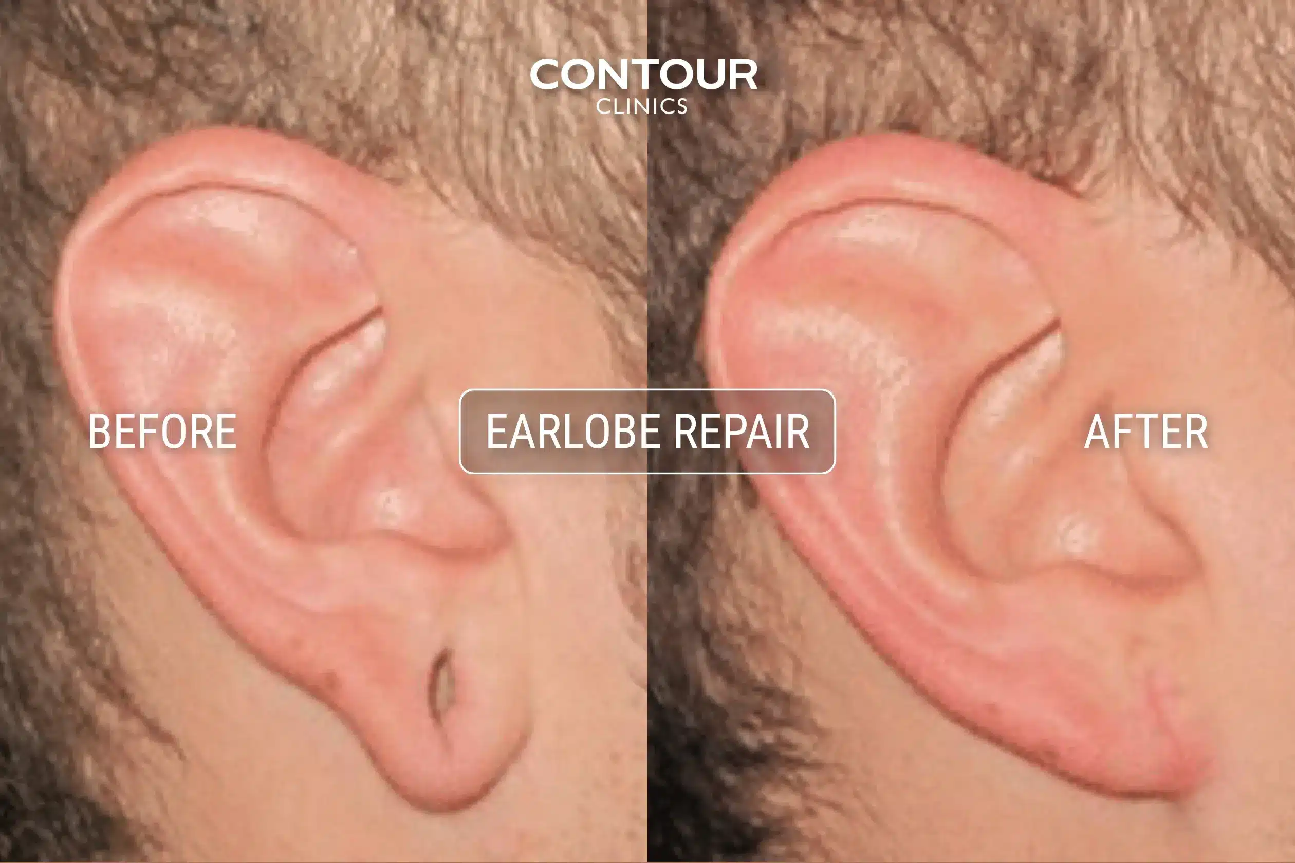 Stretched earlobe surgery before and after image at Contour Clinics