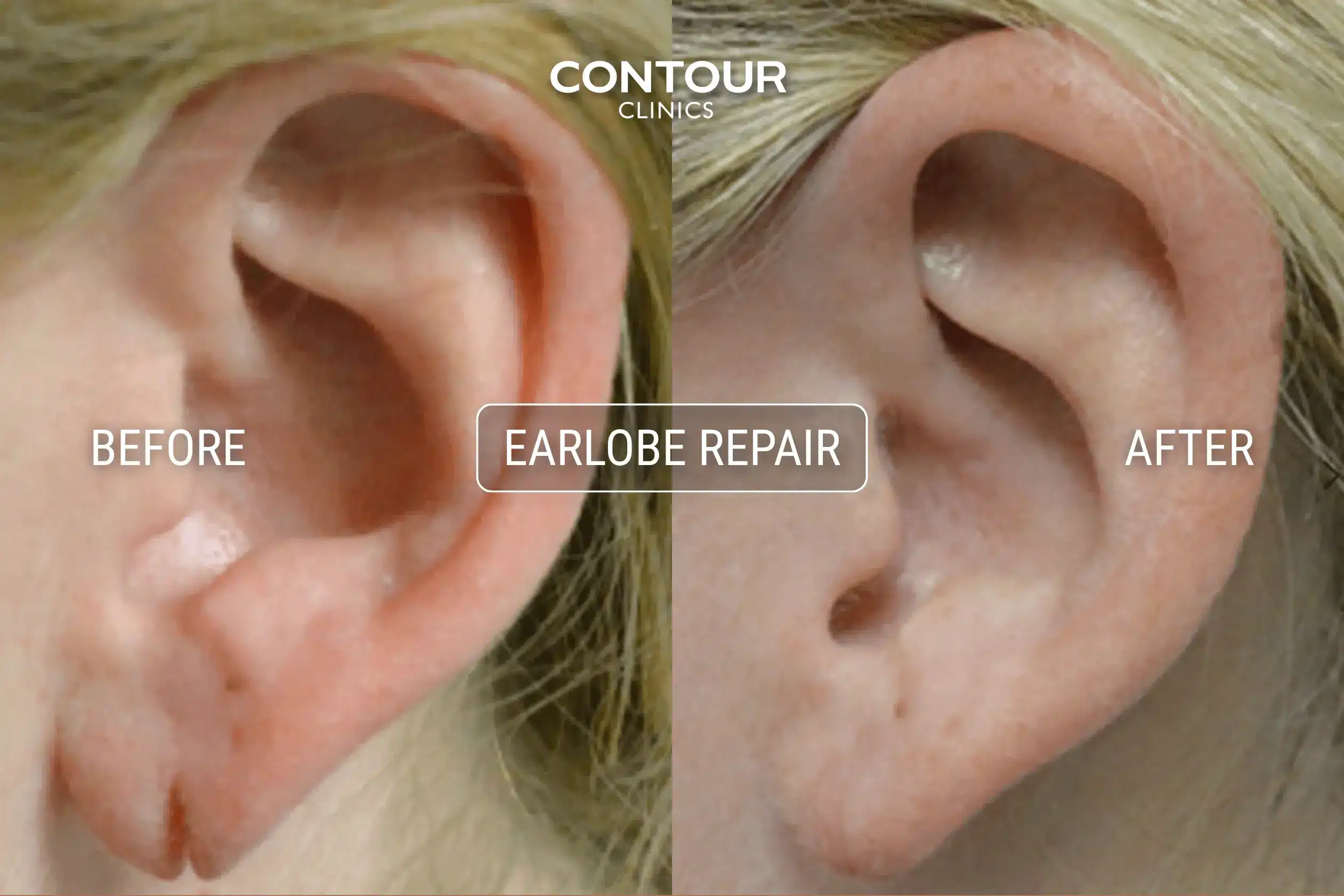 Torn earlobe repair before and after image at Contour Clinics