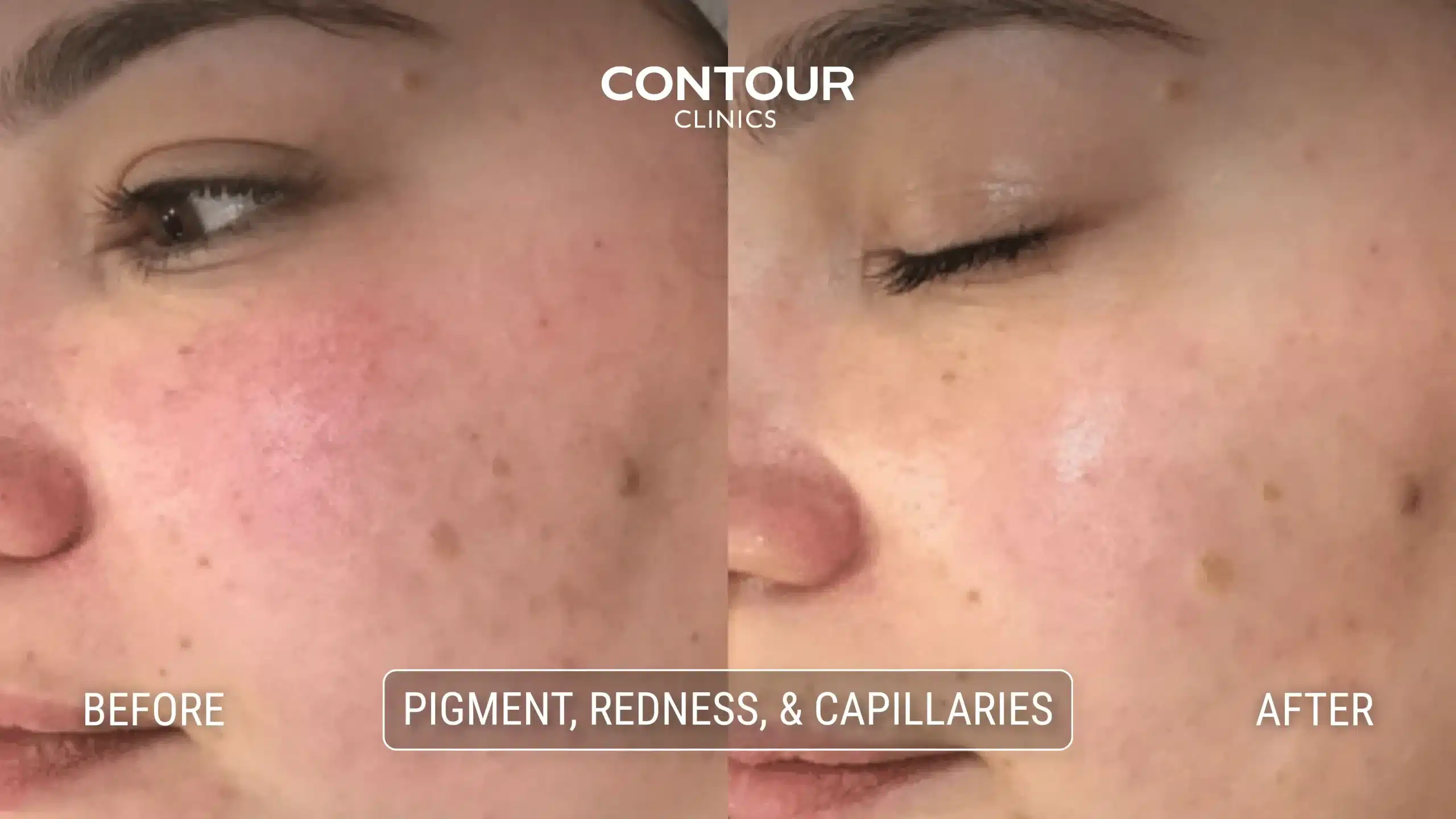 Before and after IPL treatemnt for pigment, redness and capillaries at Contour Clinics