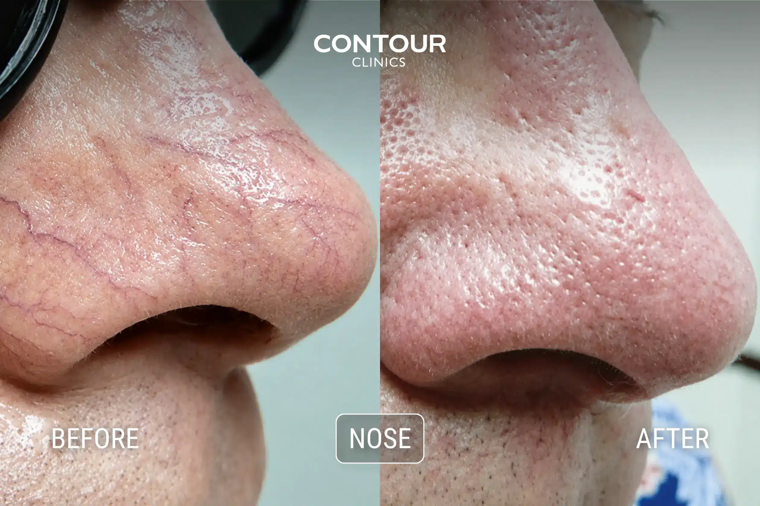 Before and after IPL treatment to nose capillaries