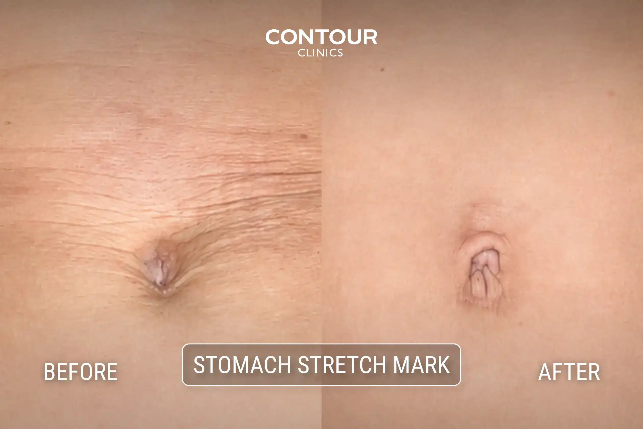 Before and after Morpheus8 treatment on stomach with stretch marks at Contour Clinics