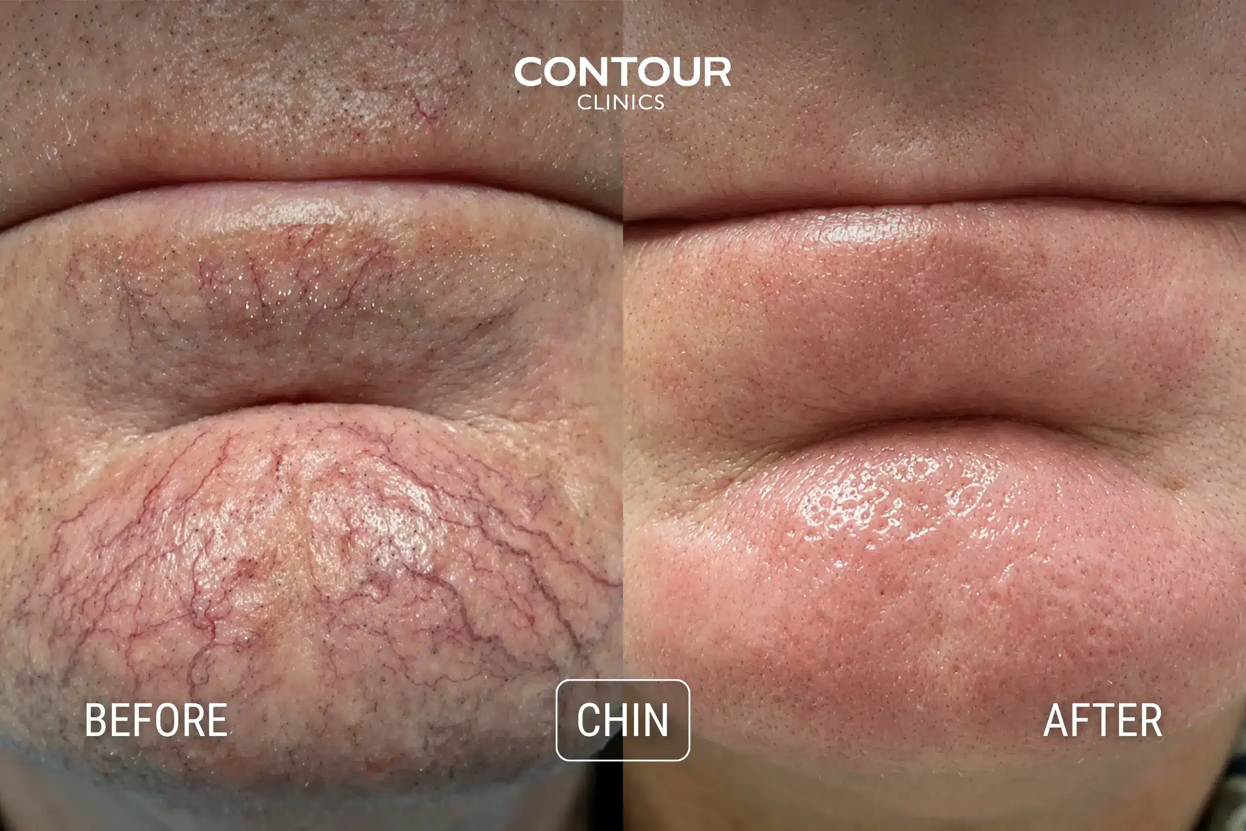 Before and after Nd YAG treatment for capillaries on chin