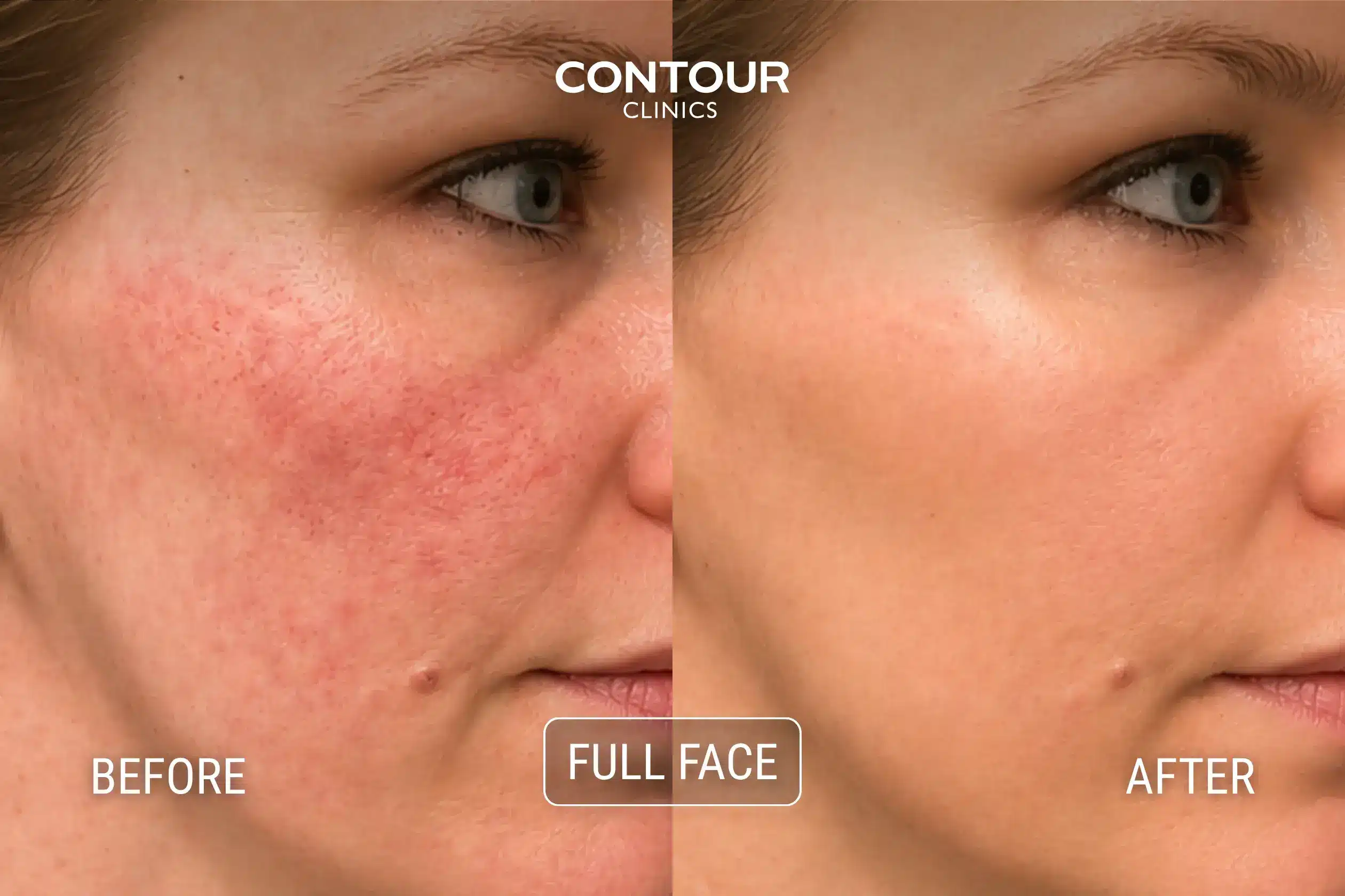 Before and after full face treatment for redness and rosacea with IPL at Contour Clinics