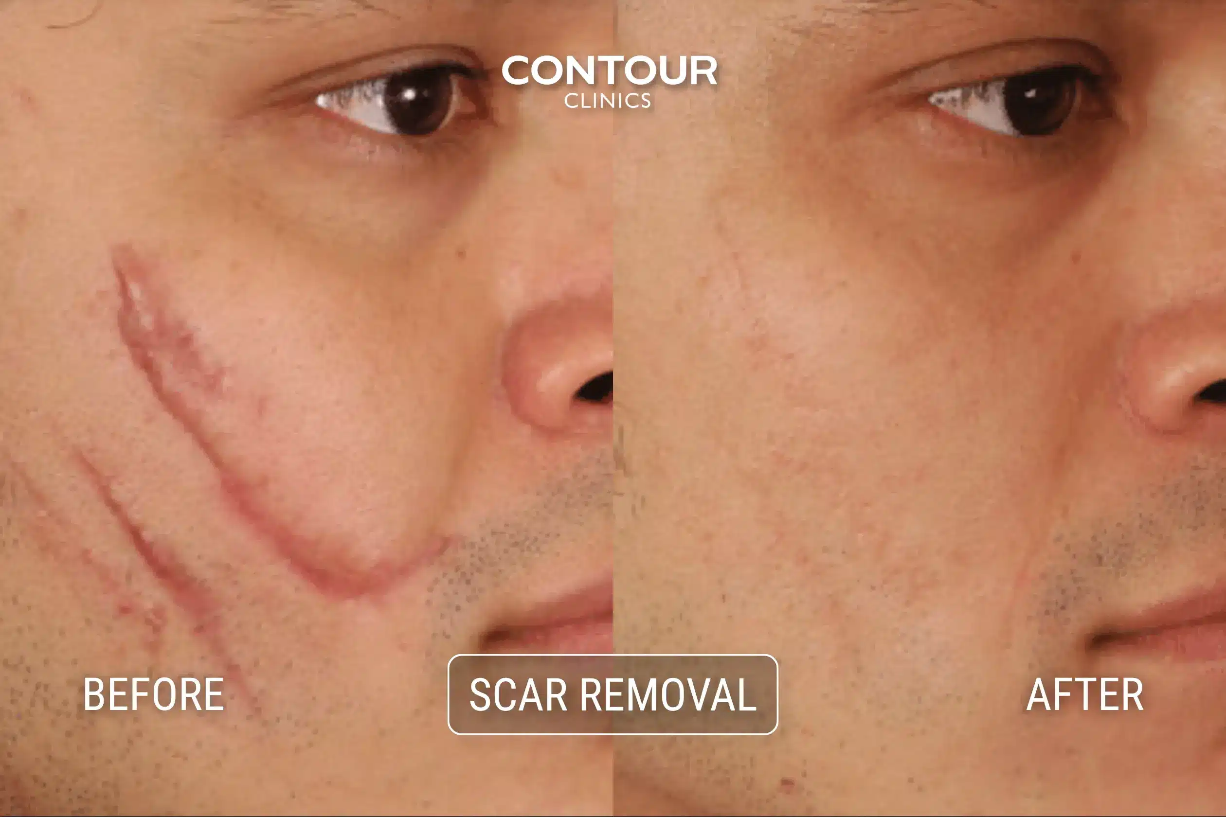 Before and after laser removal scar at Contour Clinics