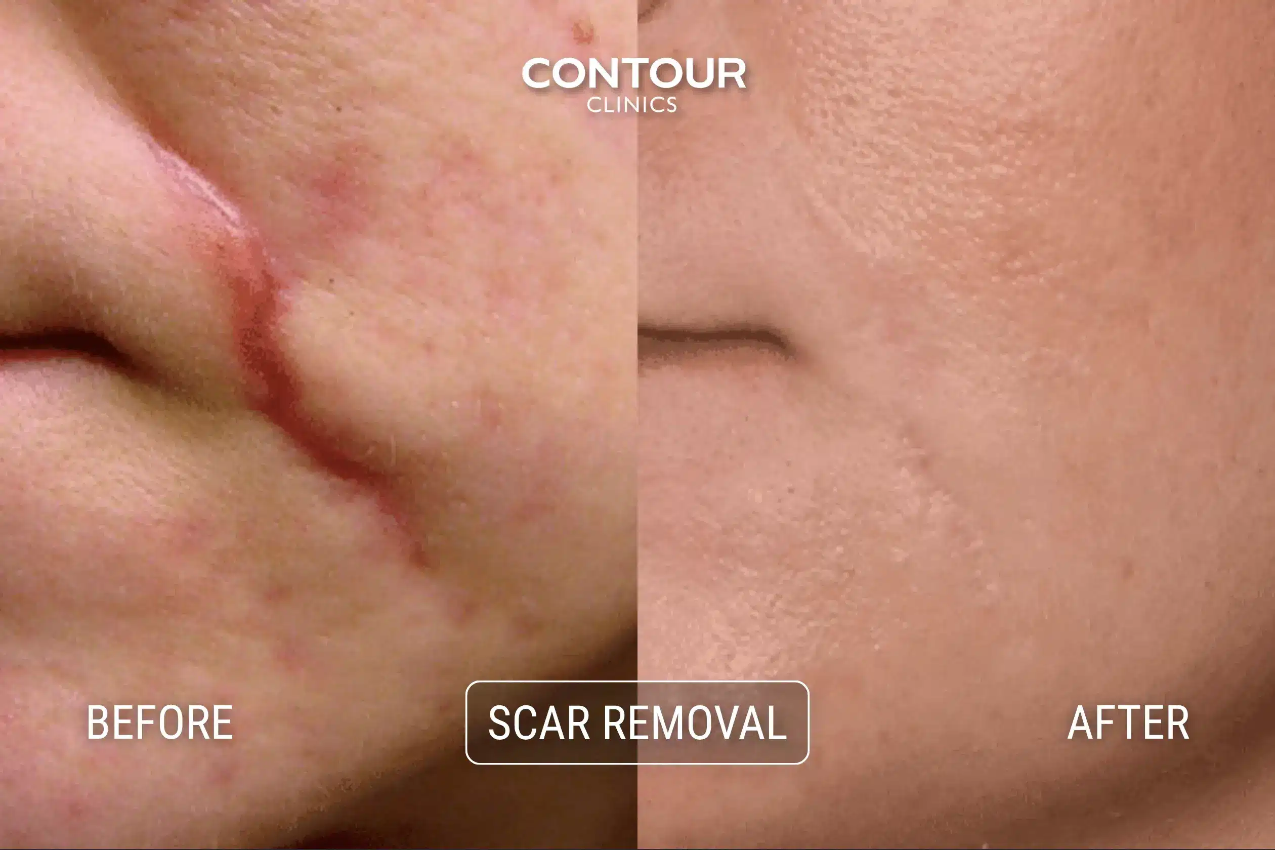 Before and after laser scar removal at Contour Clinics