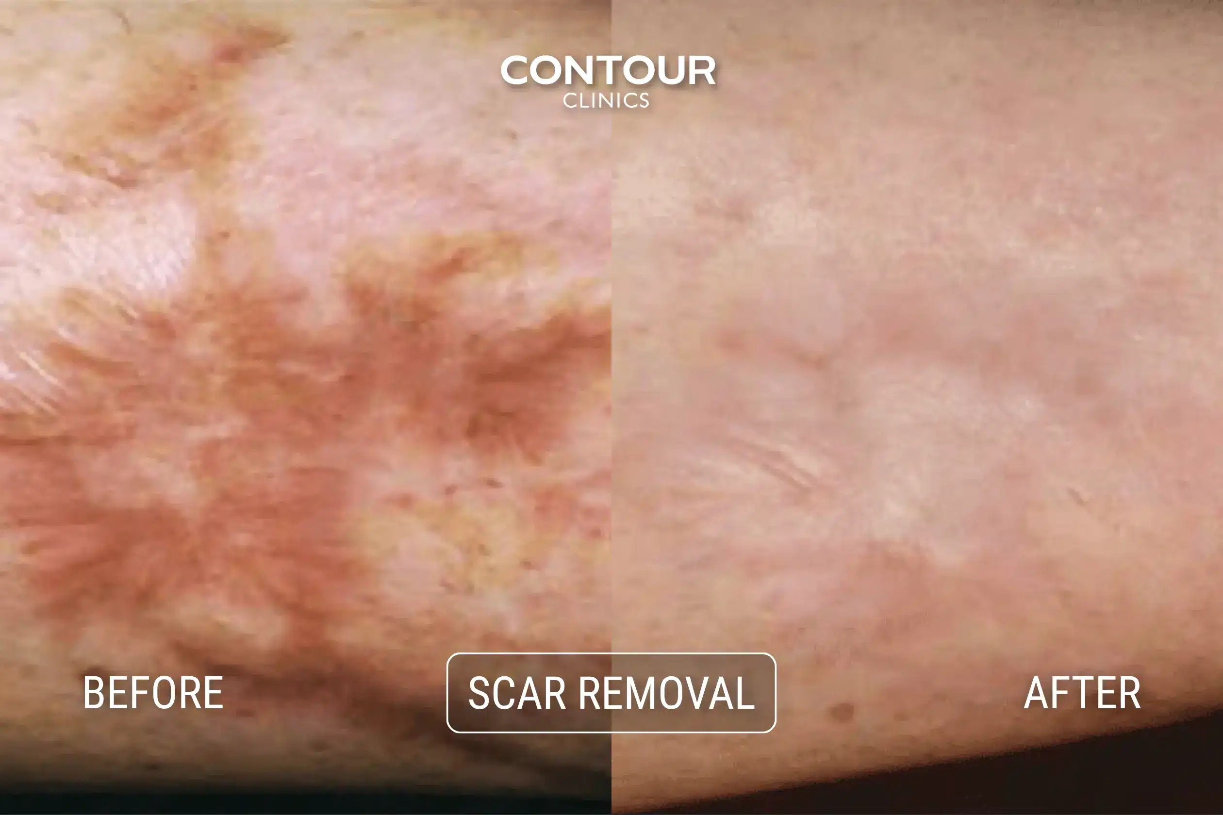 Before and after laser scar removal - real results at Contour Clinics