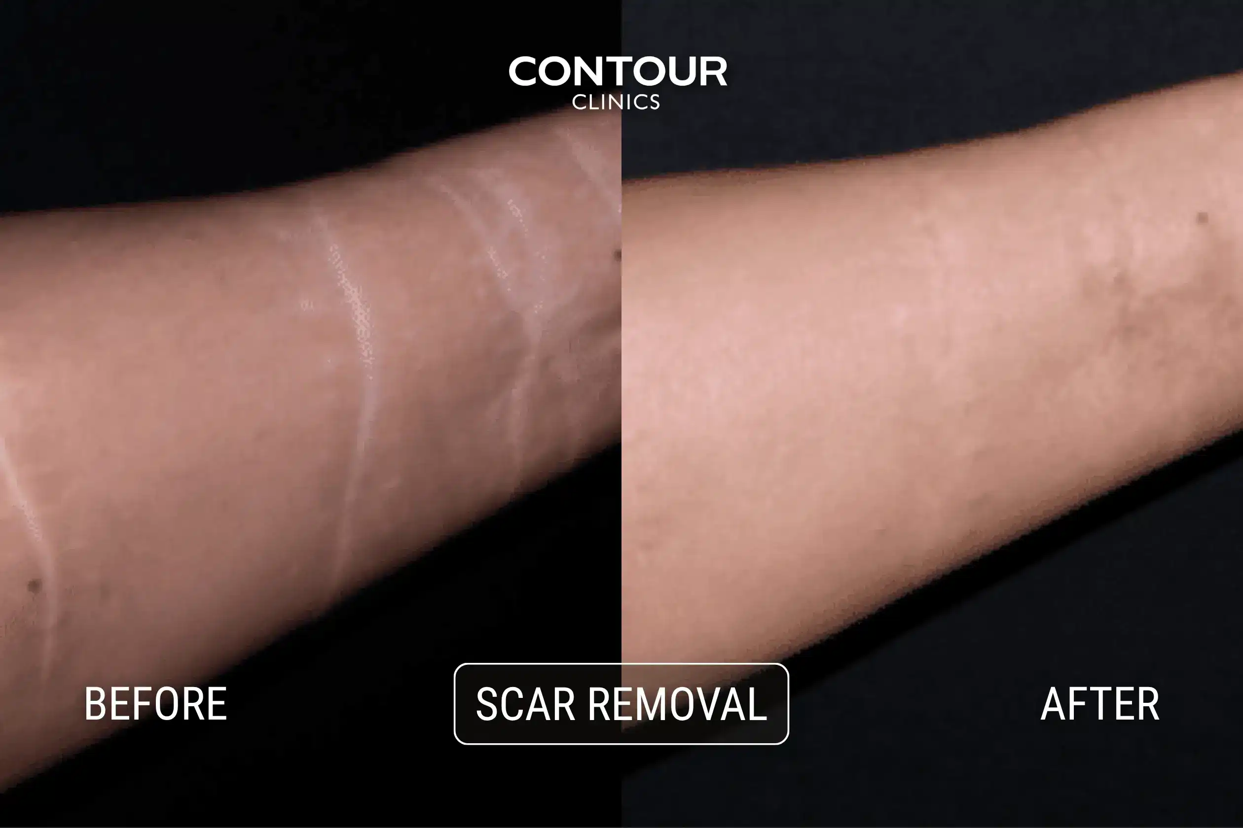 Before and after photos of laser scar removal from self harm