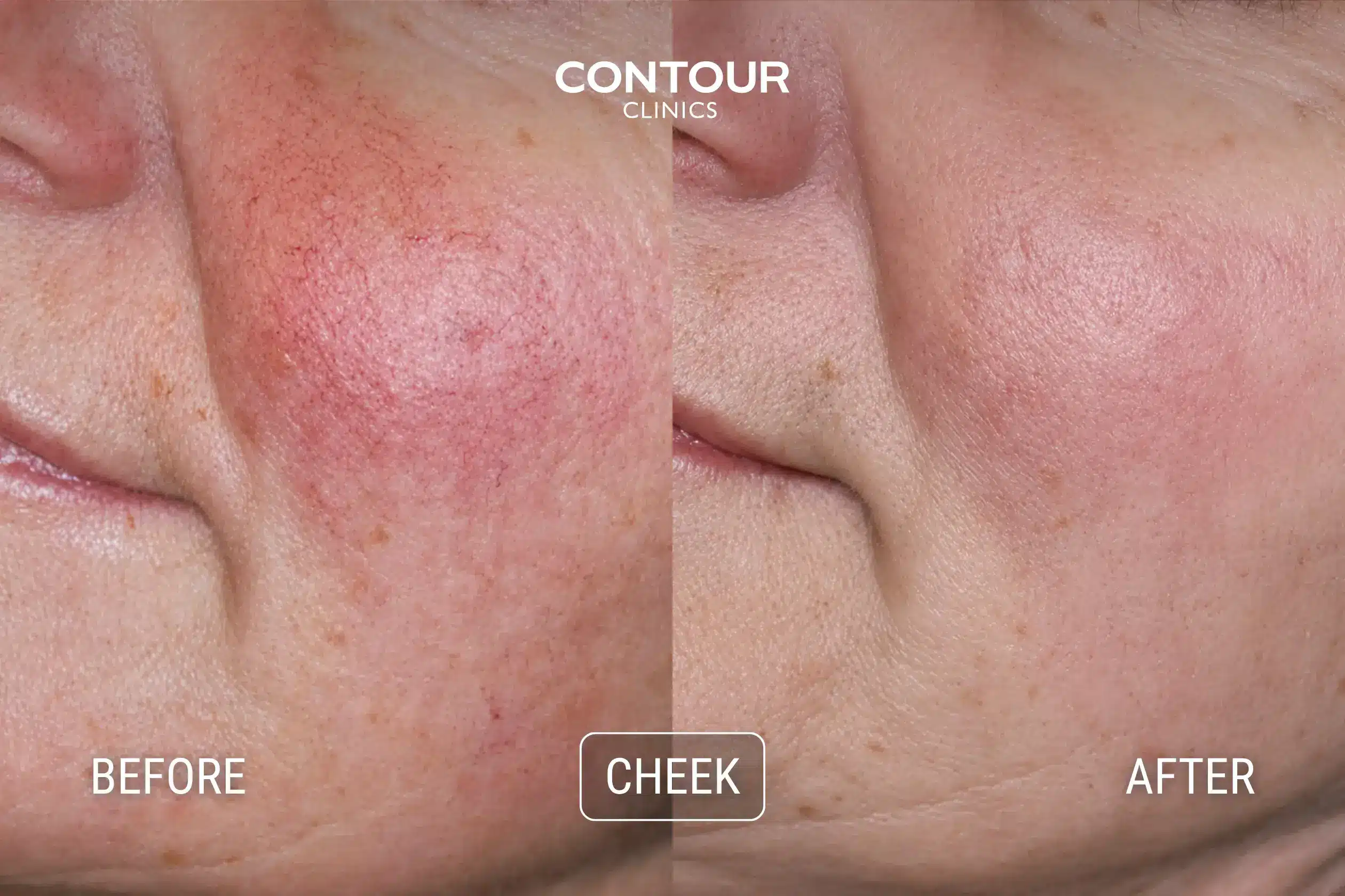 Before and after rosacea treatment to the cheeks