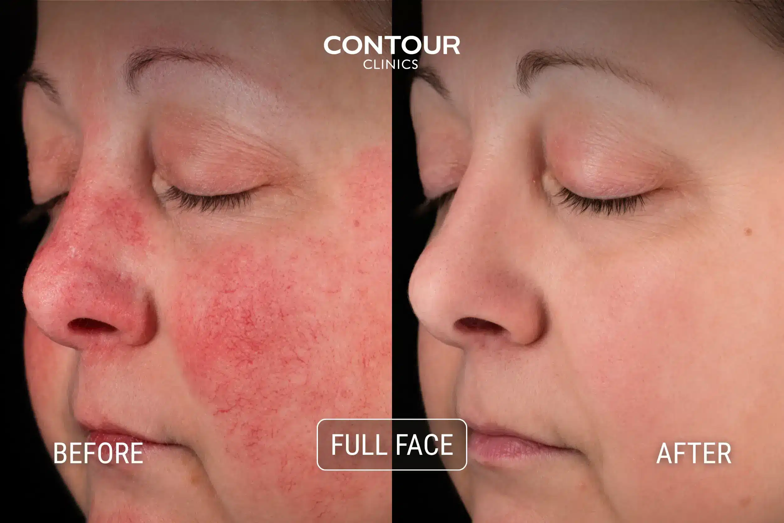 Before and after treatment for redness and rosacea with IPL at Contour Clinics