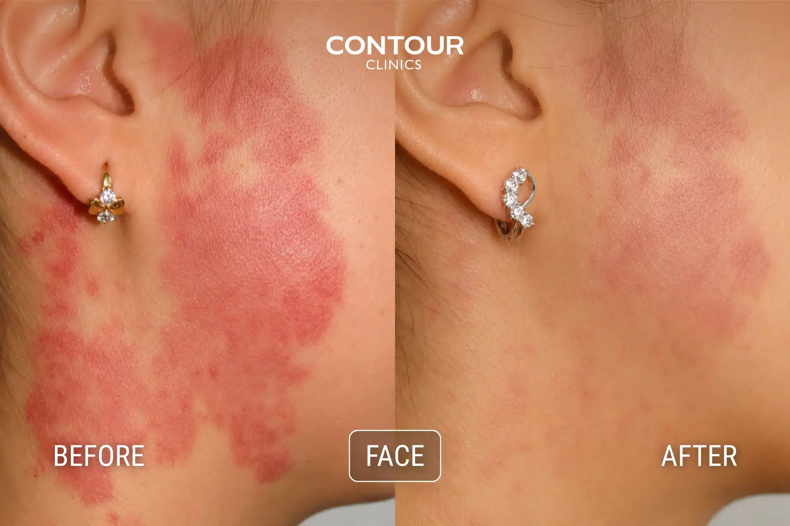 Before and after vascular treatment for facial redness