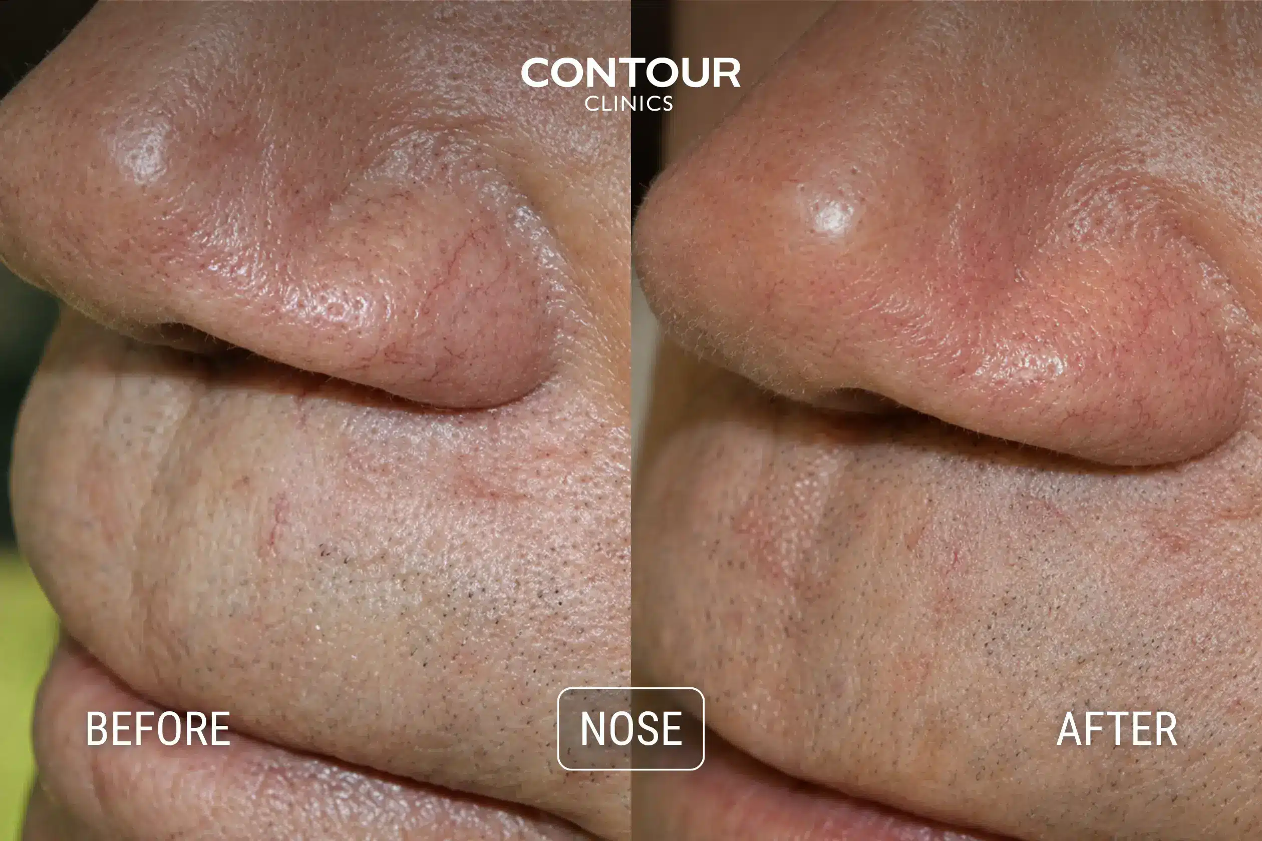 Before and immediately after long pulse Nd Yag to nasal vessels