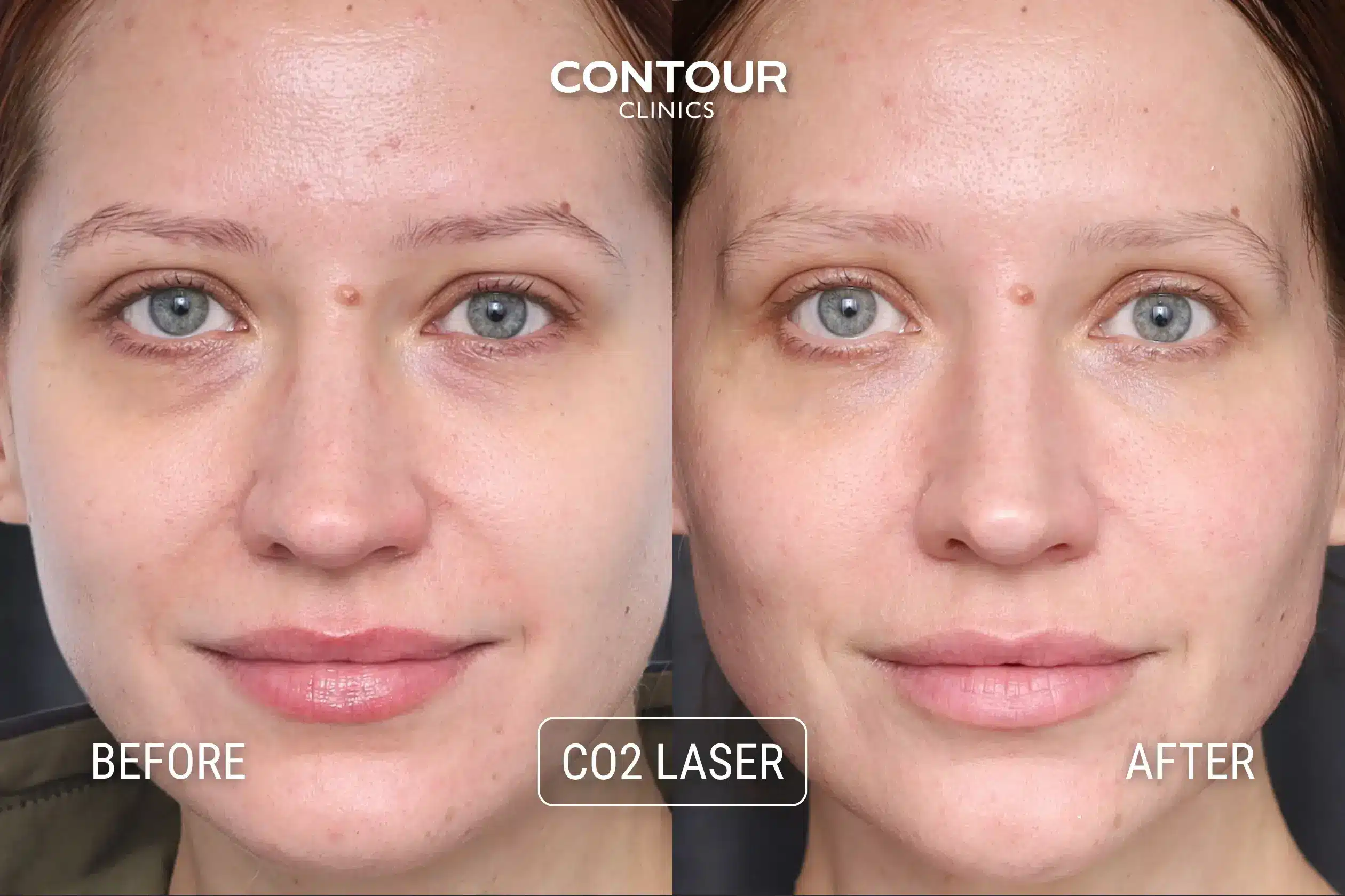 Co2 laser for face before and after at Contour Clinics