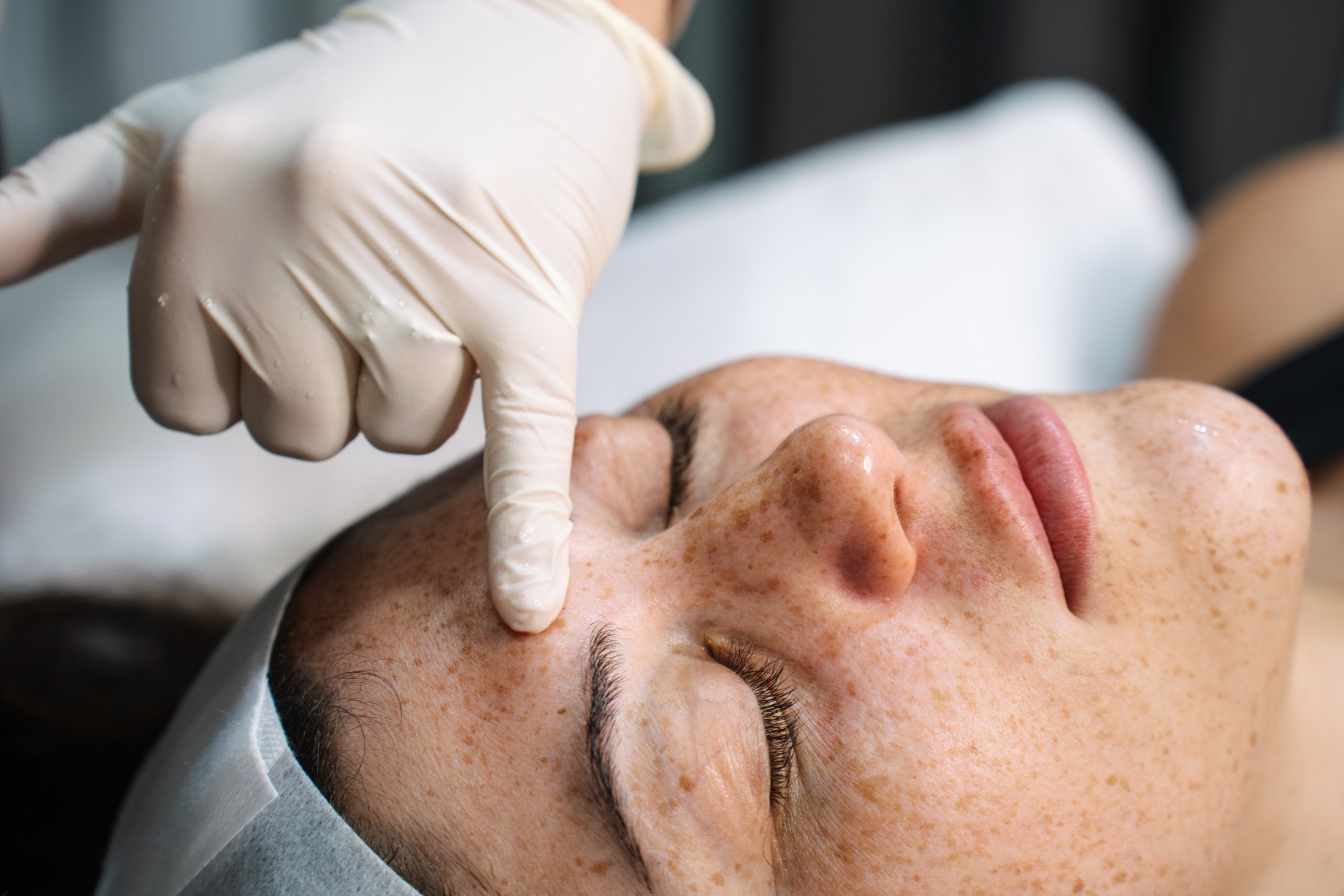 Melasma & Pigmentation Removal Treatment options with cosmetic doctors in Sydney & Brisbane