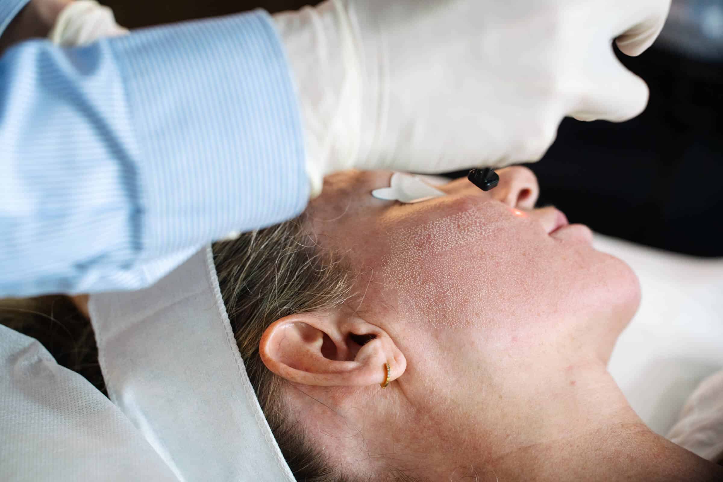 Melasma and Pigmentation Removal Laser Treatment Options