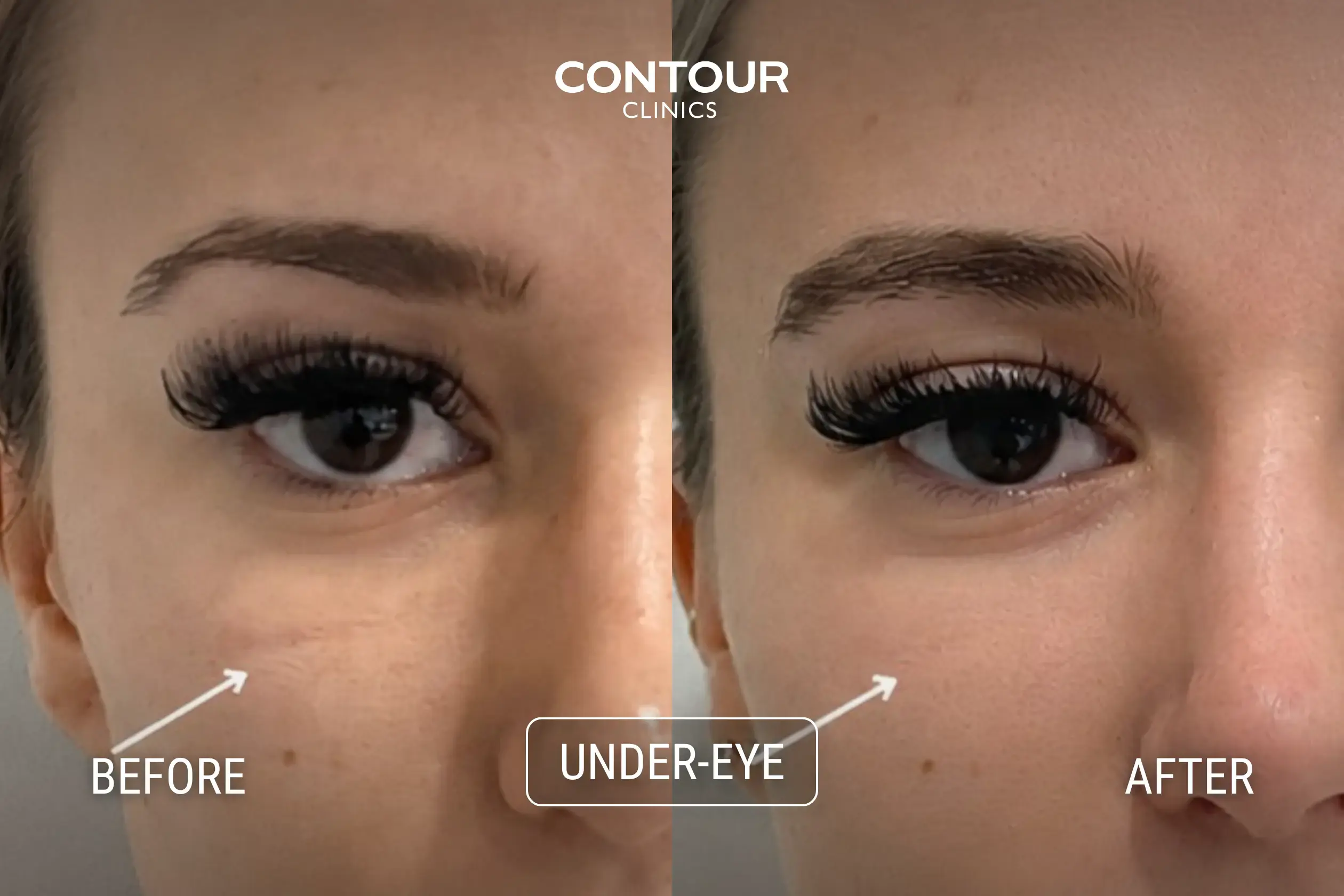 Morpheus 8 before and after treatment in under eye and upper cheek area