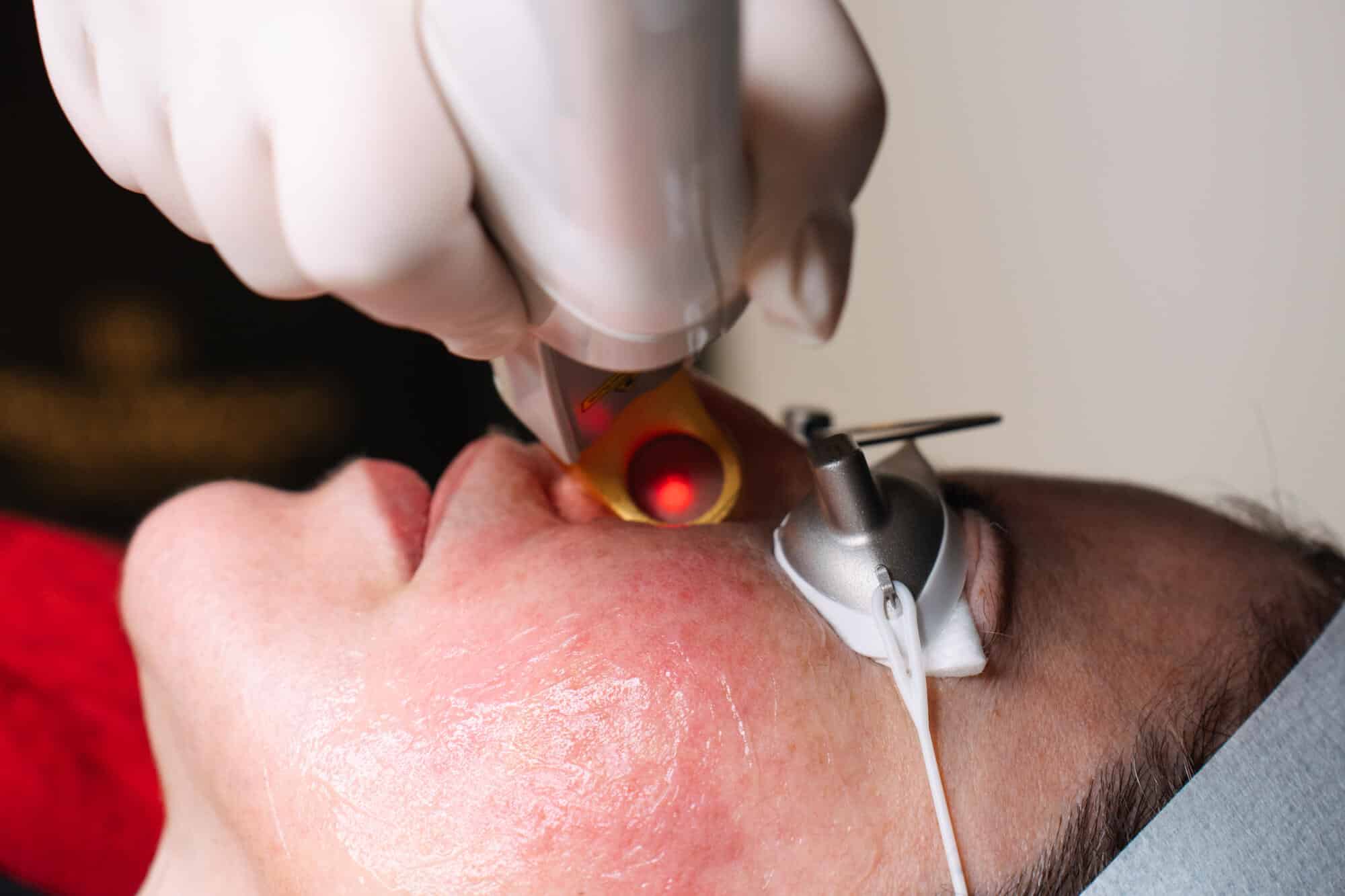Redness & Rosacea - Treatment for Red Spots on Face with cosmetic and laser practitioners at Contour Clinics