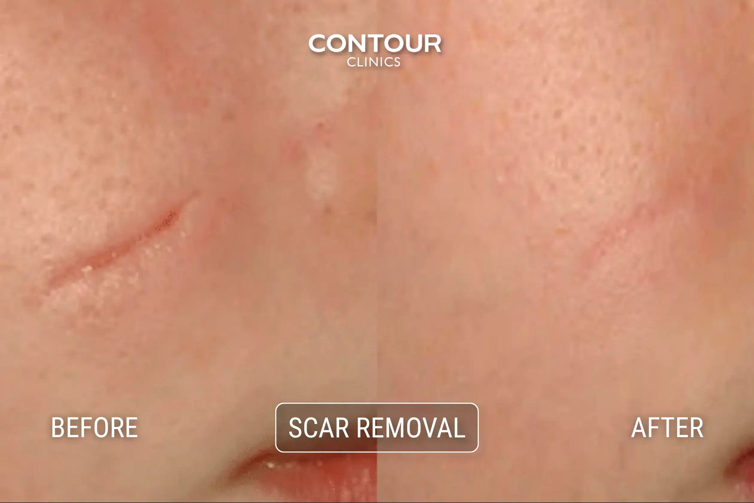 Scar treatment before and after laser scar removal at Contour Clinics