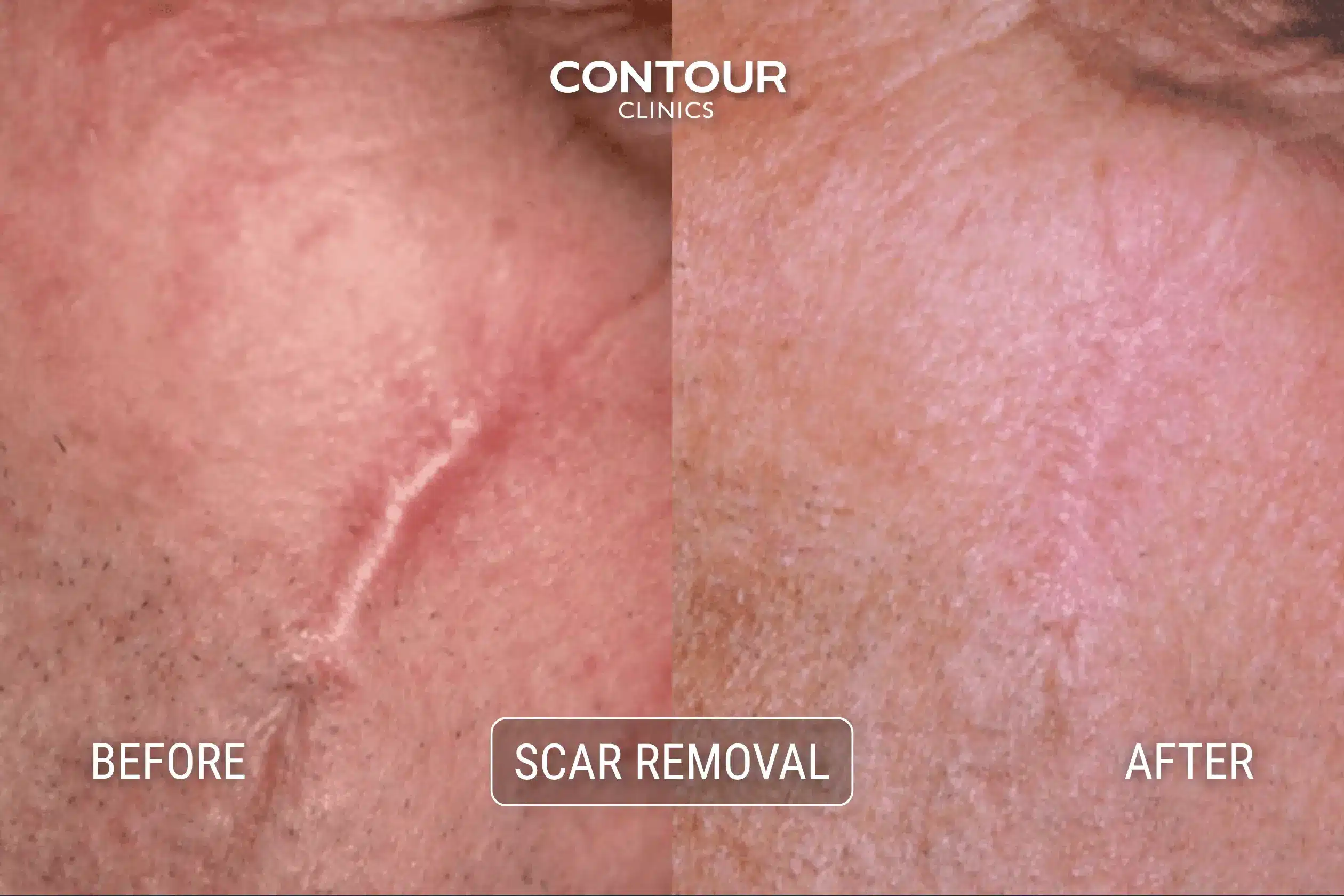 Scar treatment before and after photos at Contour Clinics