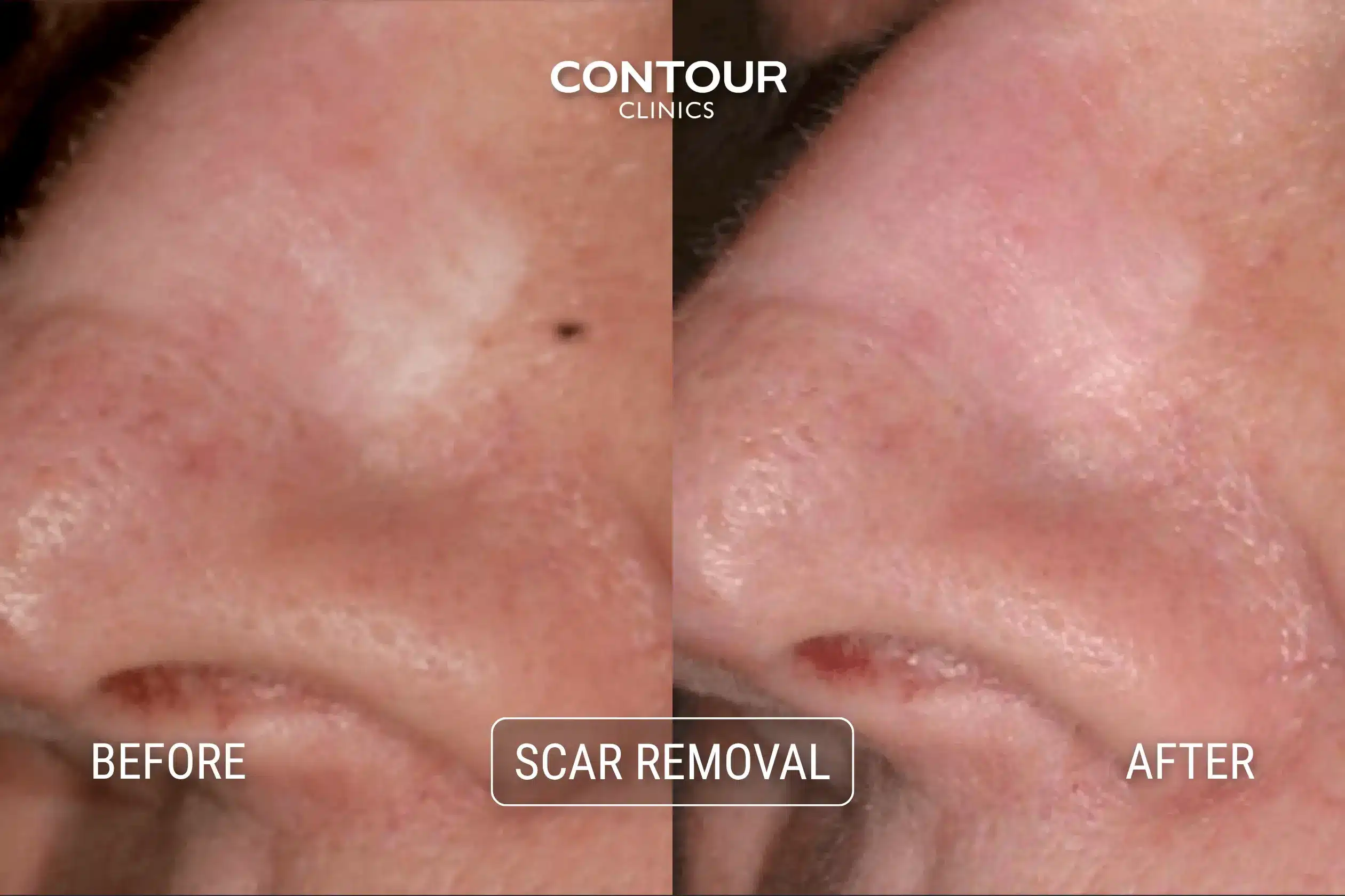 Scars on face before and after laser scar removal