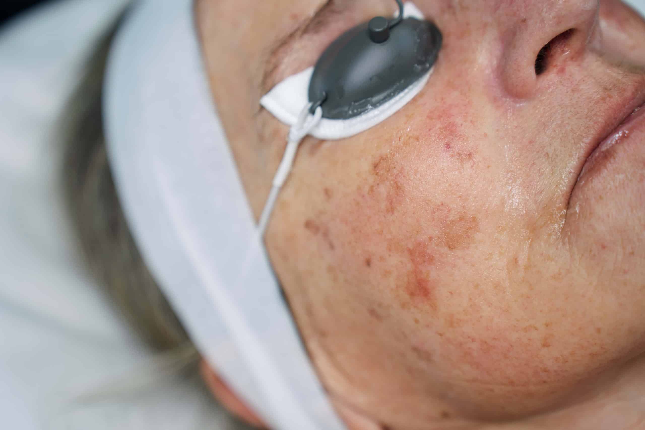 What Causes Facial Redness and how to treat it