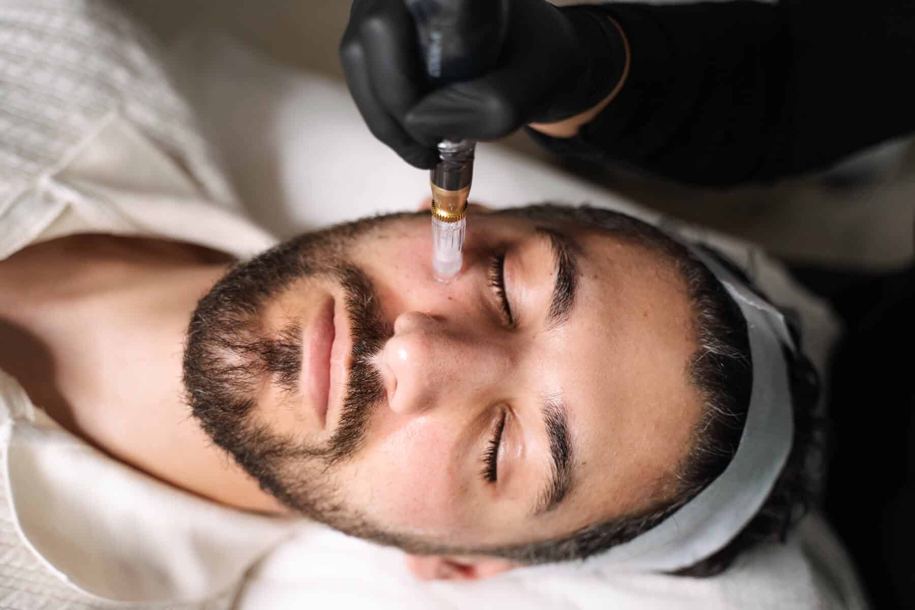 What is skin needling - defined by cosmetic practitioners