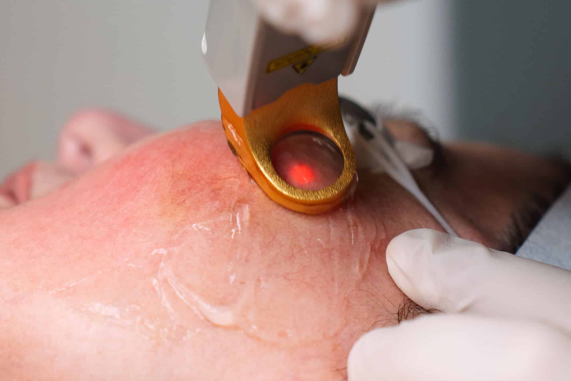 What to Expect at Your Rosacea and Facial Redness Consultation