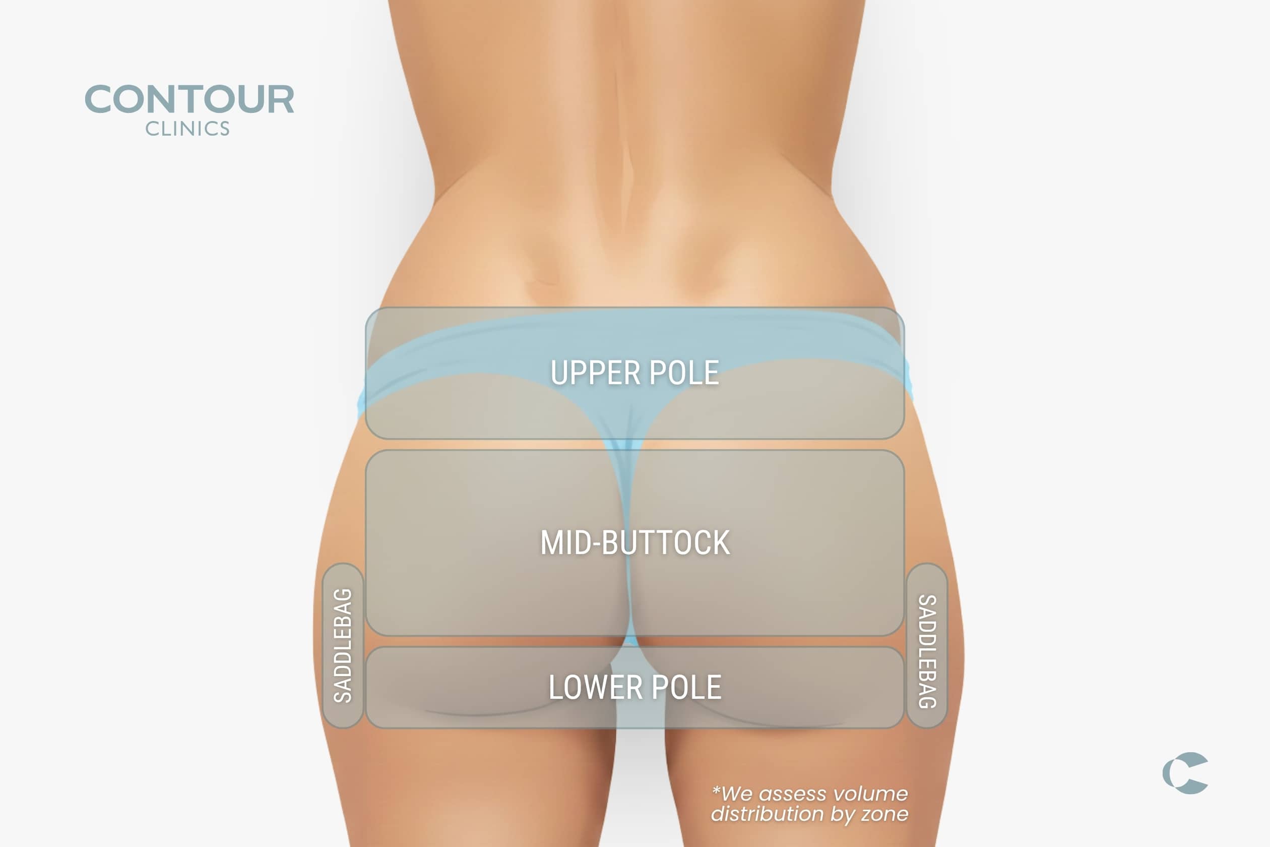 What may be assessed in a butt contouring consultation in Sydney and Brisbane at Contour Clinics
