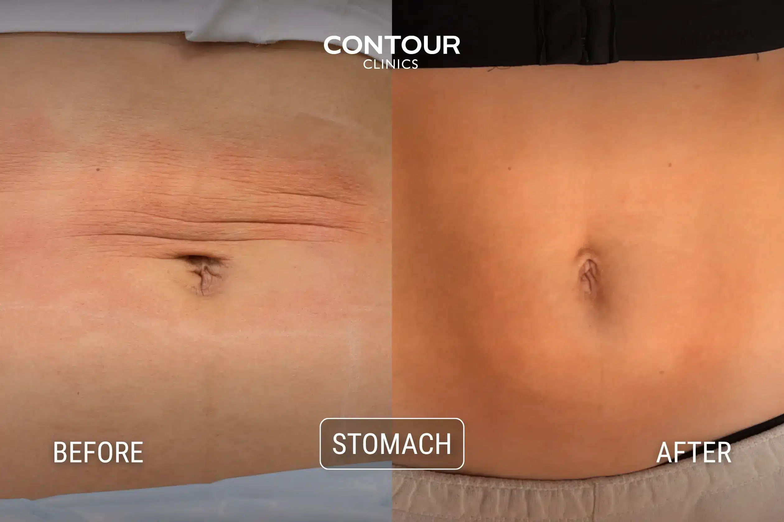 Before and after Morpheus8 treatment on the stomach for skin tightening at Contour Clinics