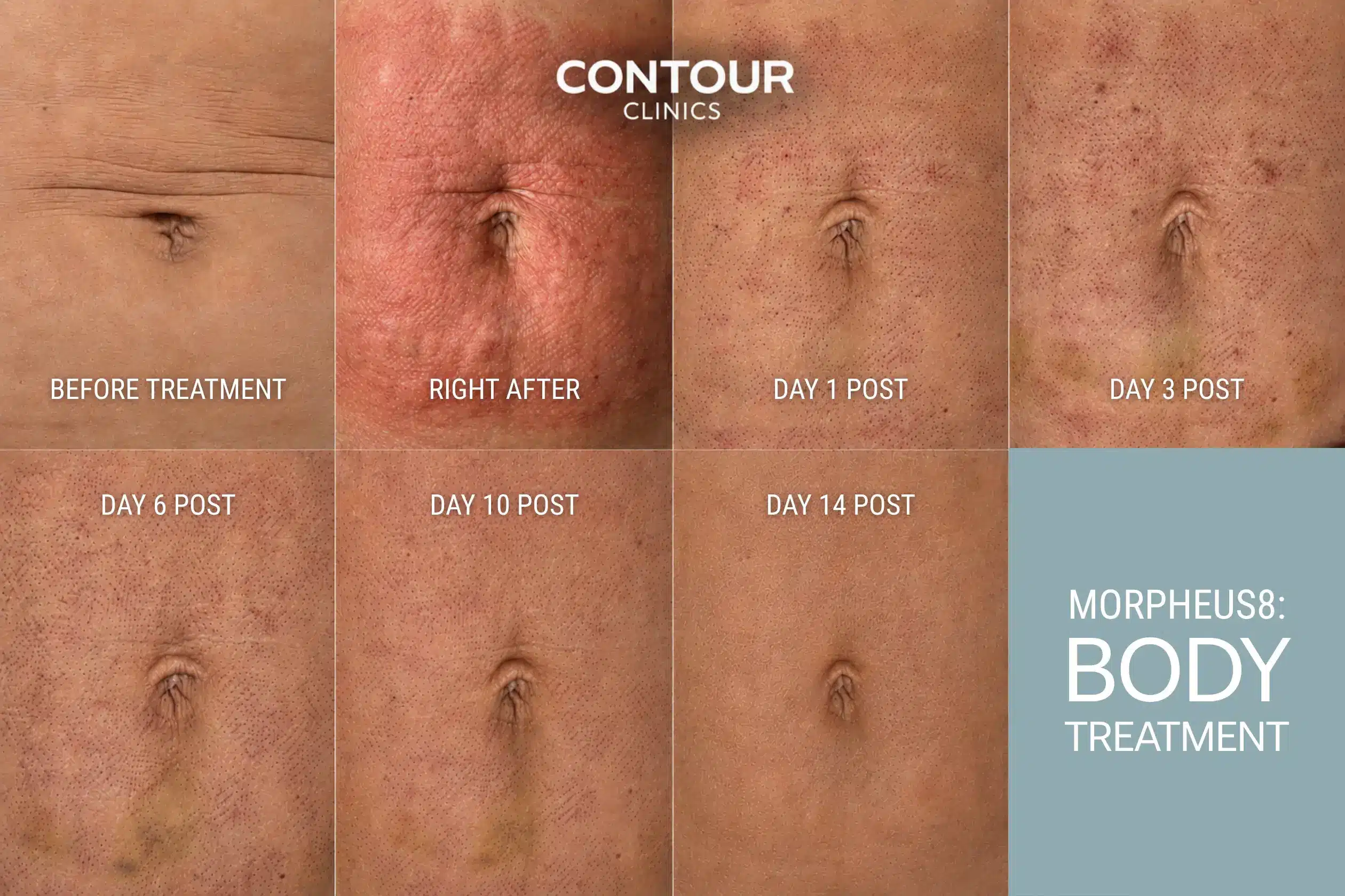 Images showing day by day recovery after Morpheus8 treatment for stomach fat remodelling at Contour Clinics