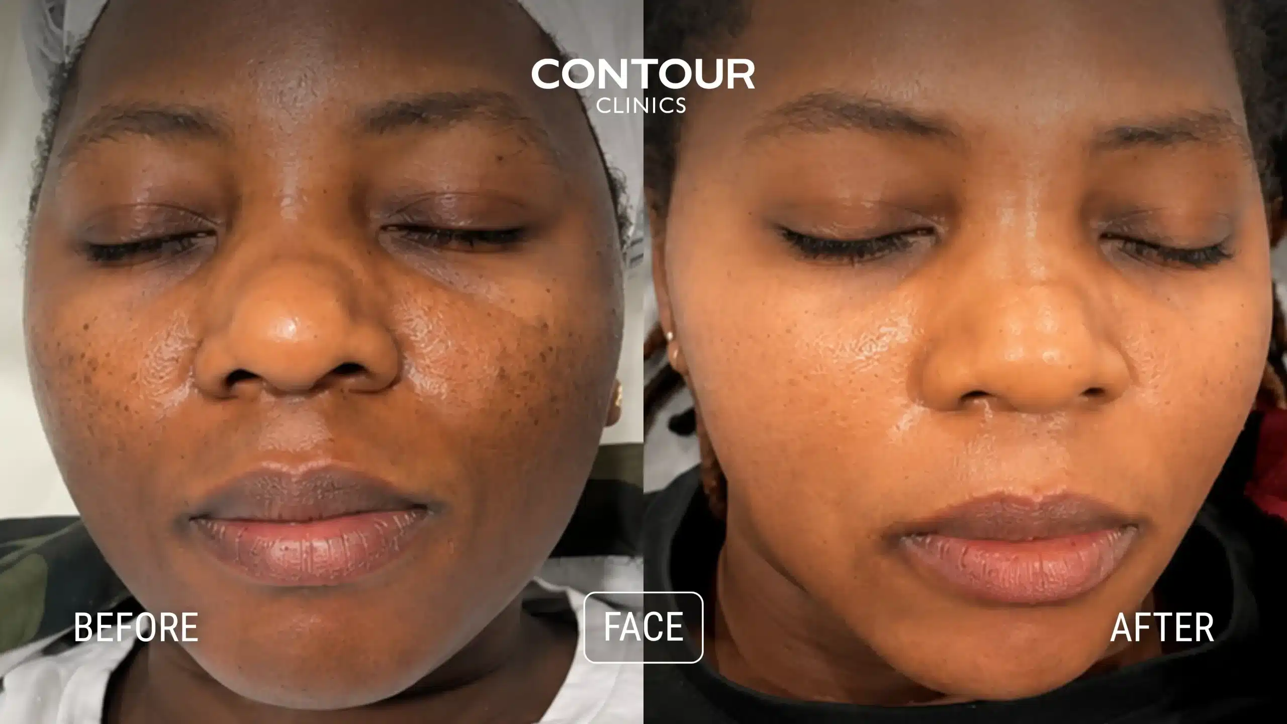 Before and after one Cosmelan Peel showing reduced pigmentation on a dark skin tone
