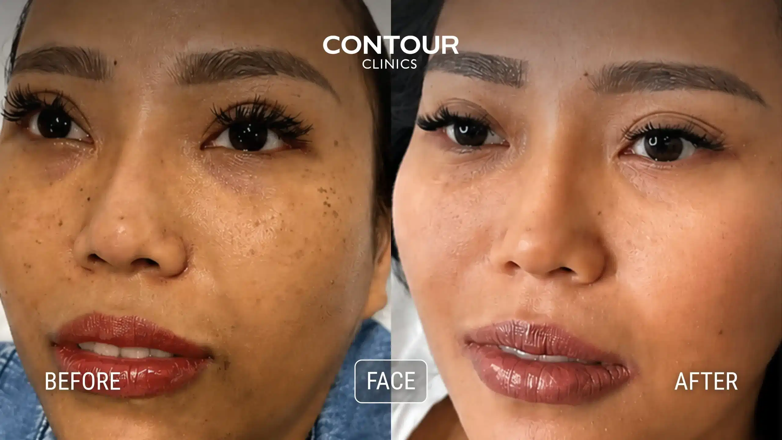 Before and after one Cosmelan Peel showing reduced pigmentation on Asian skin