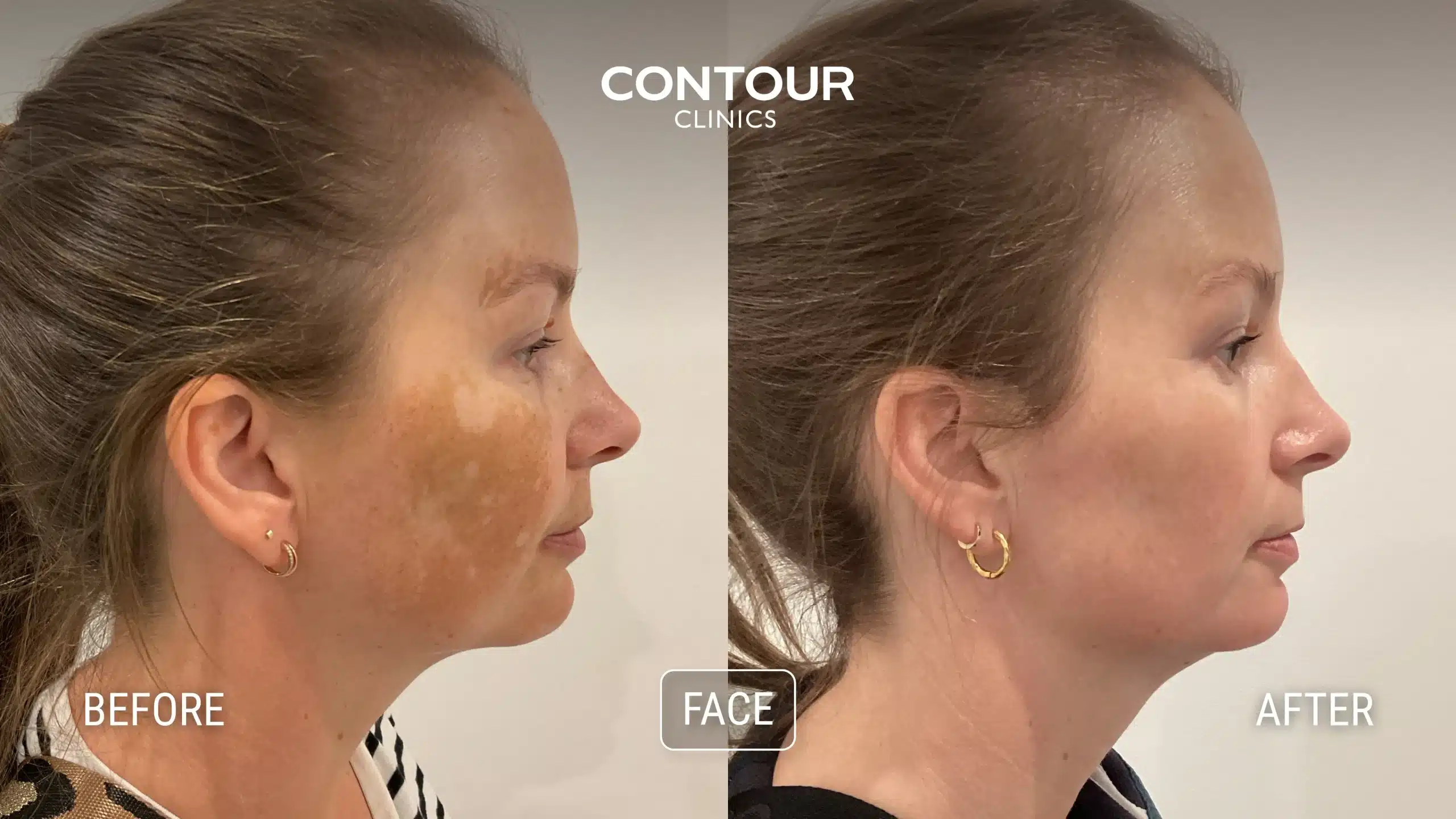 Cosmelan Peel before and after treatment for melsama at Contour Clinics
