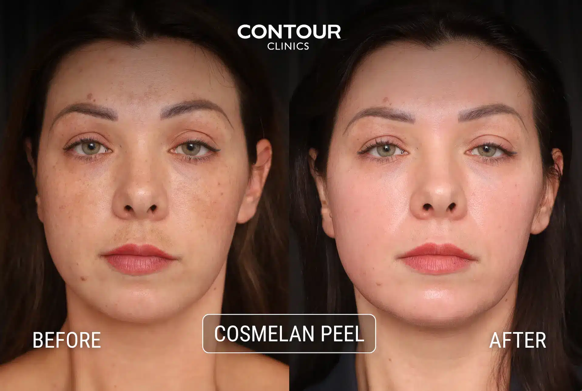 Before and after one Cosmelan peel showing the difference