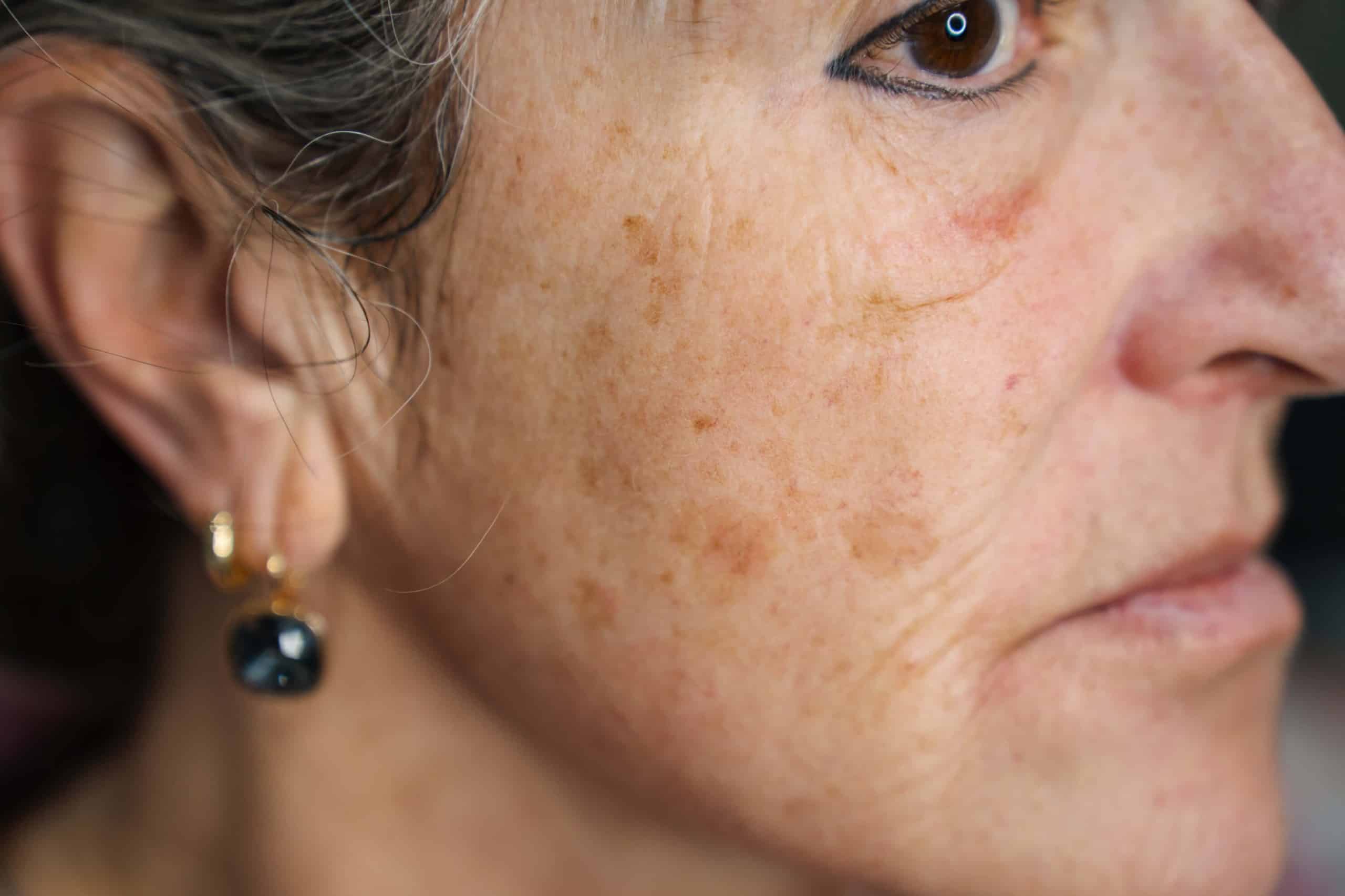 IPL laser can treat uneven skin tonem sun damage, pigmentation and more