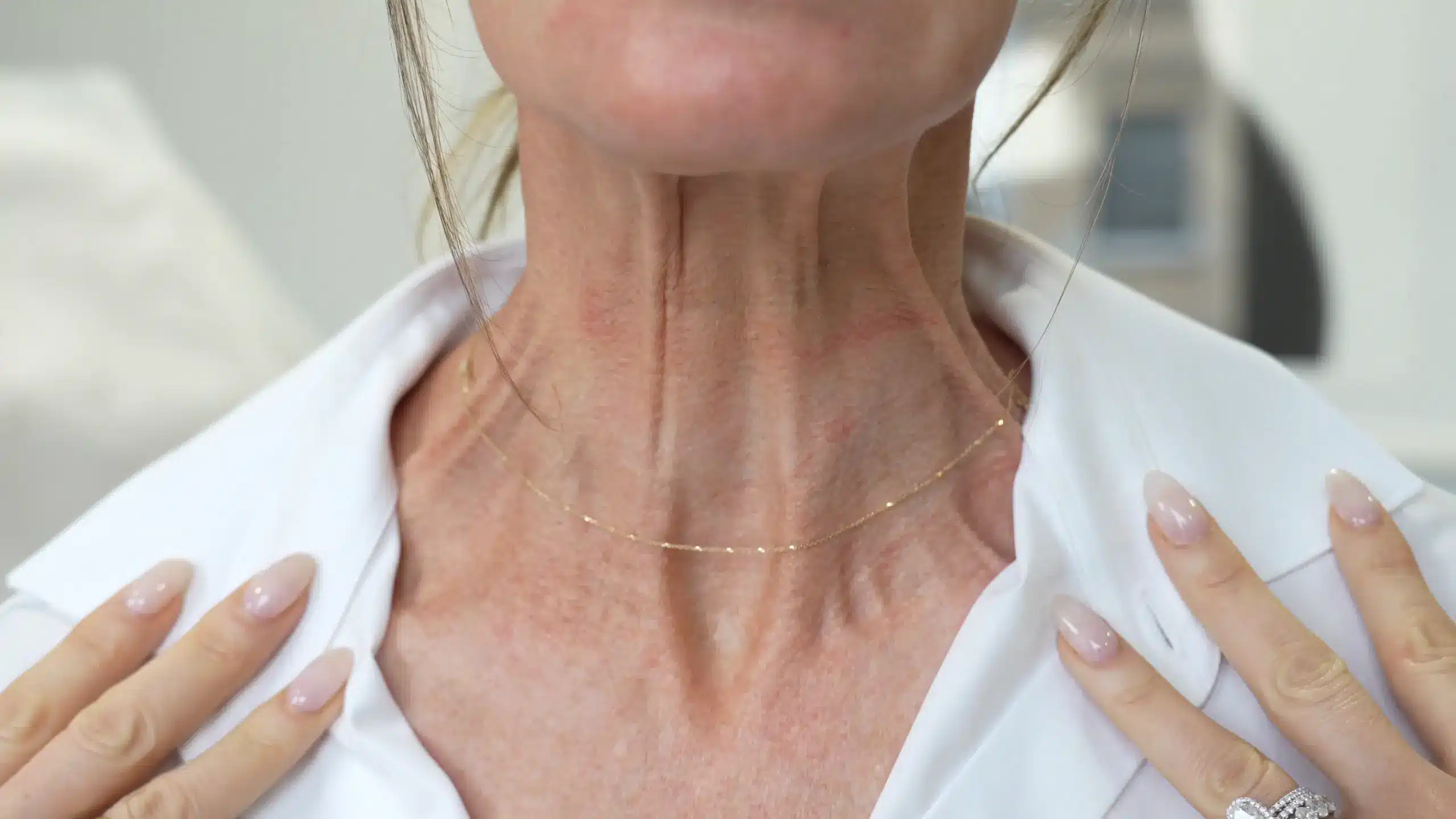 What do platysma bands look like