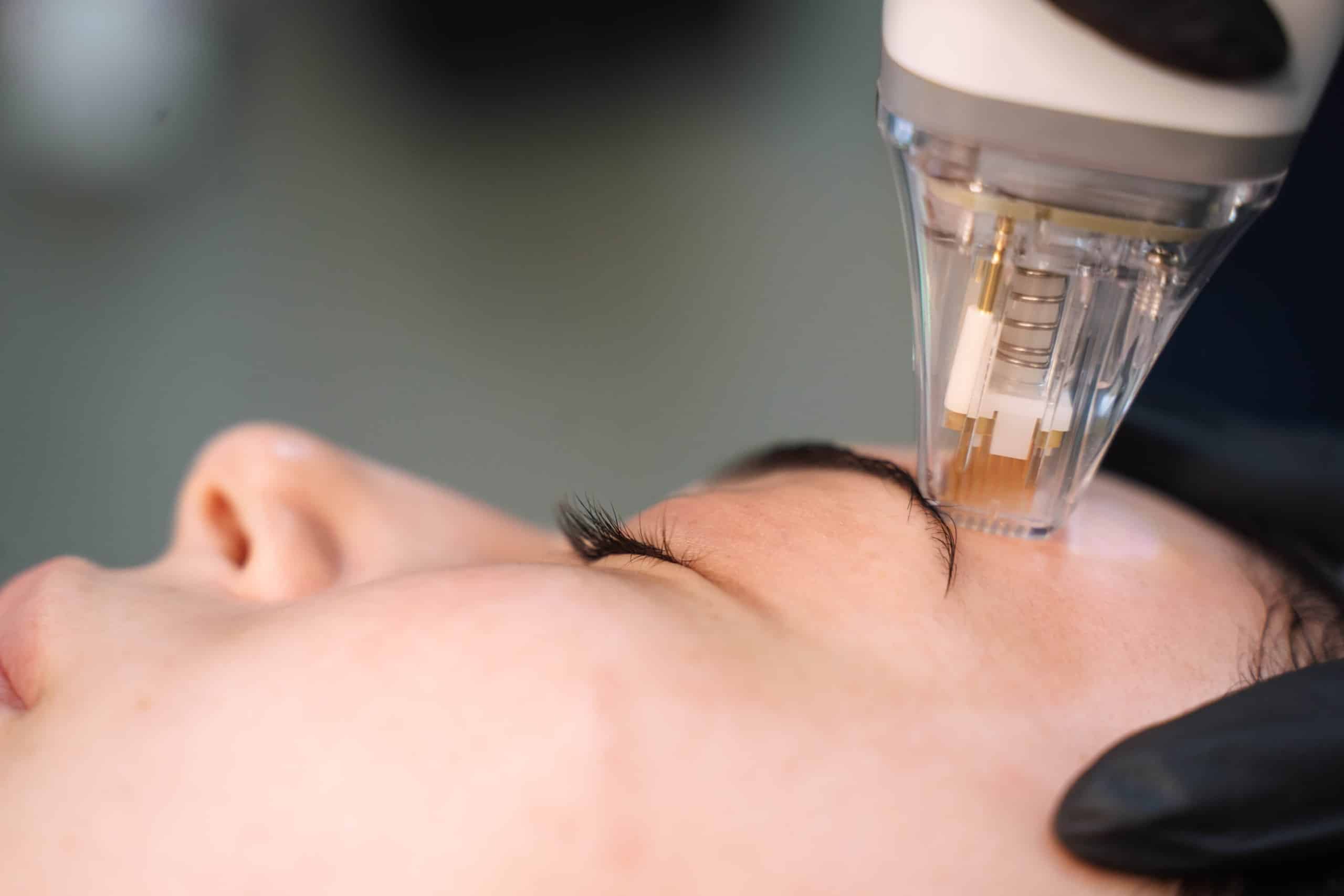 Potenza microneedling handpiece applied by a cosmetic practitioner at Contour Clinics to a patient's forehead