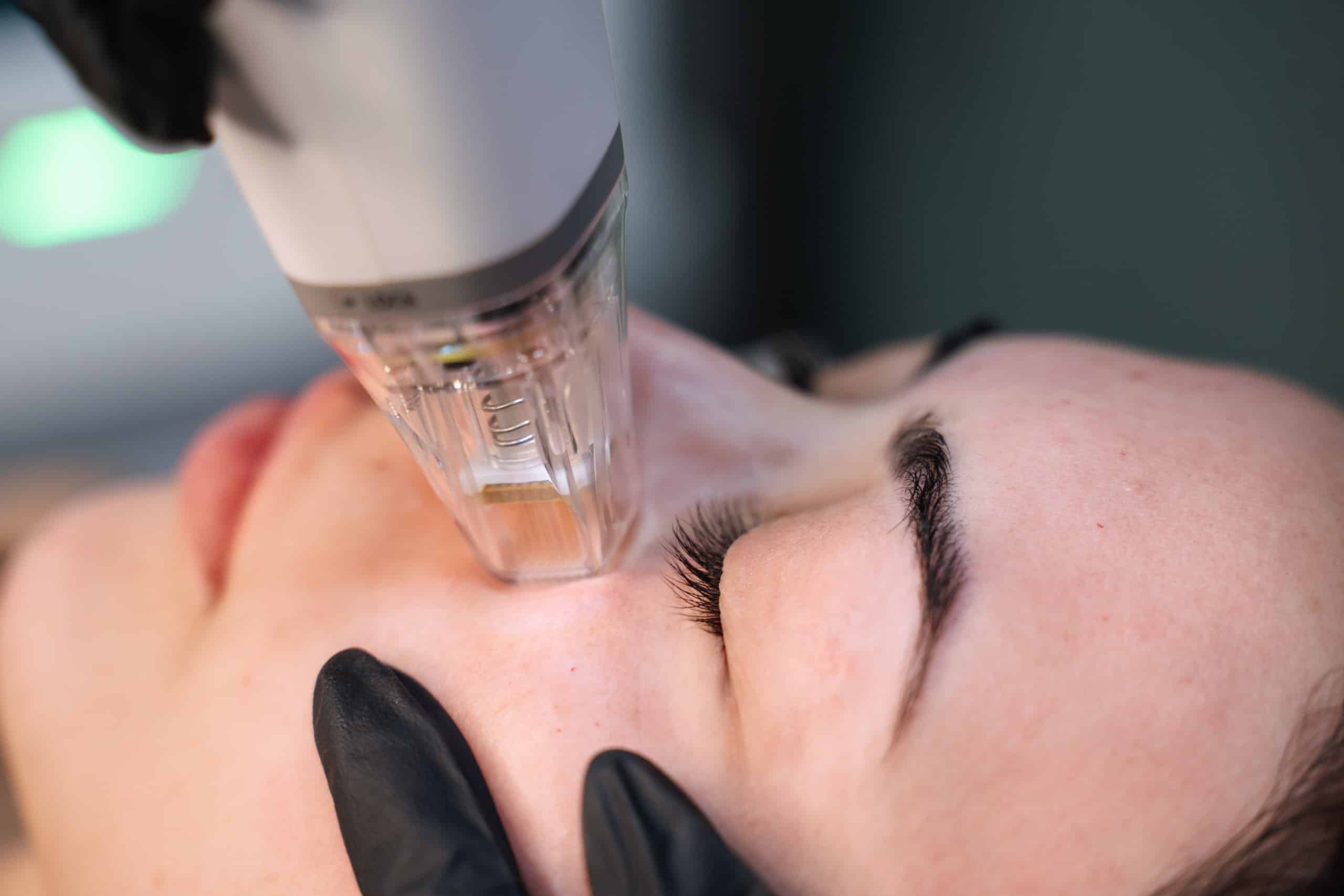 Close up of a female patient's face undergoing RF Microneedling with Potenza, with a dermal therapist at Contour Clinics