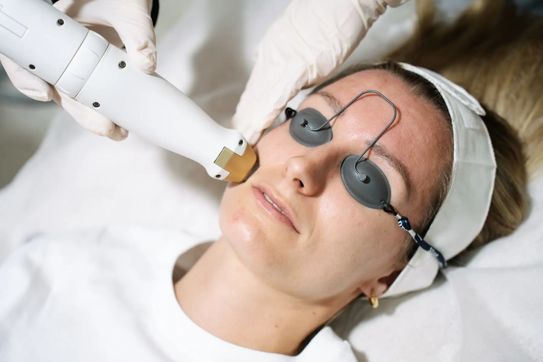1540 Fractional Non-Ablative Laser Treatment Sydney & Brisbane
