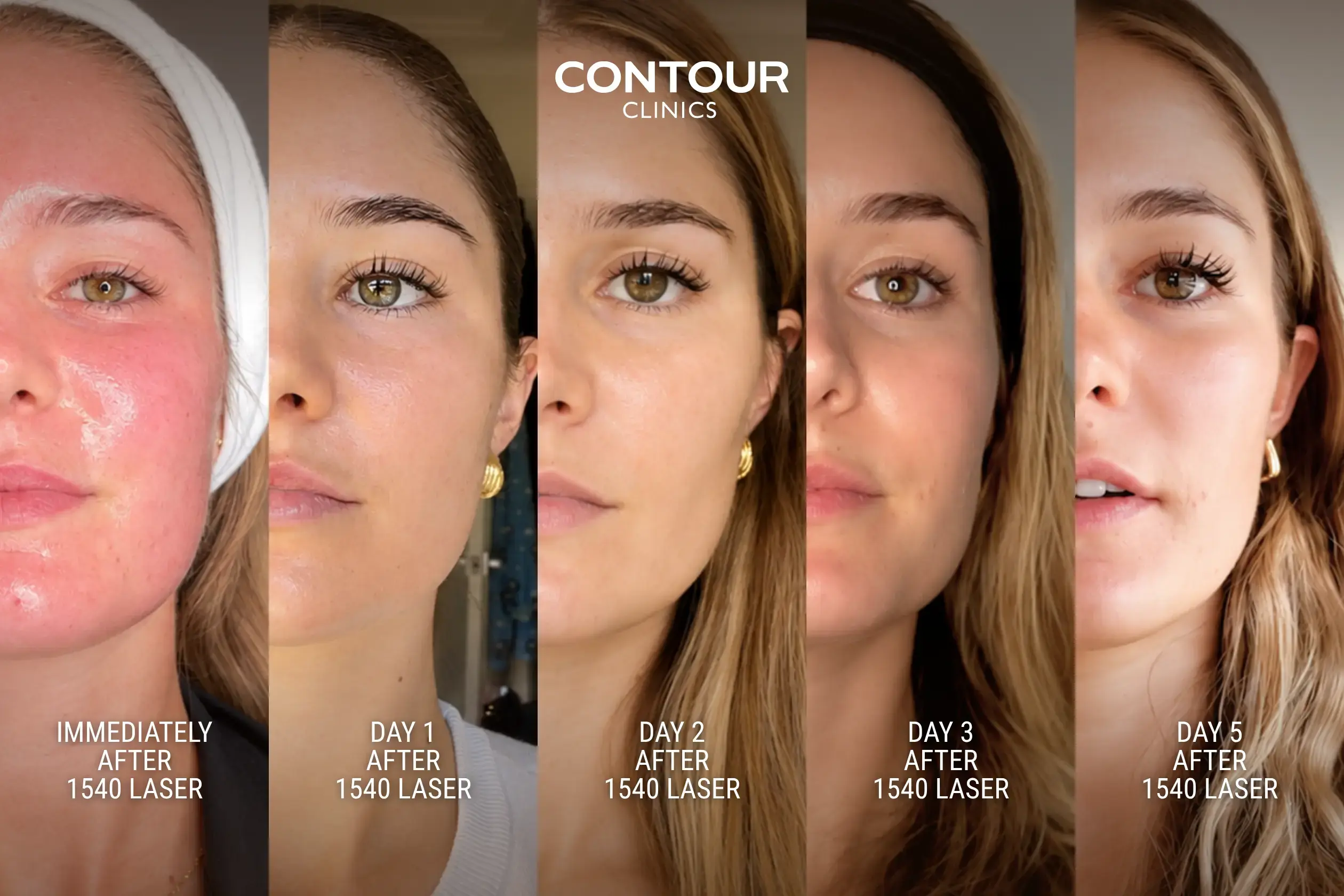 1540 fractional laser patient recovery timeline