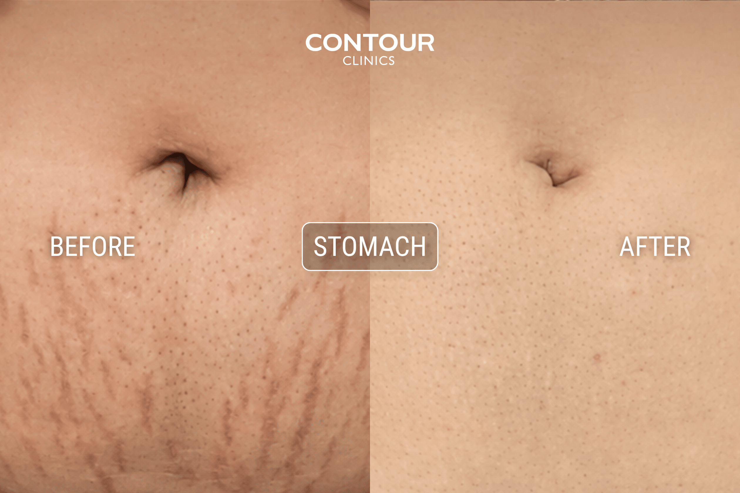 Before and after 1540 fractional laser treatment for stomach stretch marks on a female