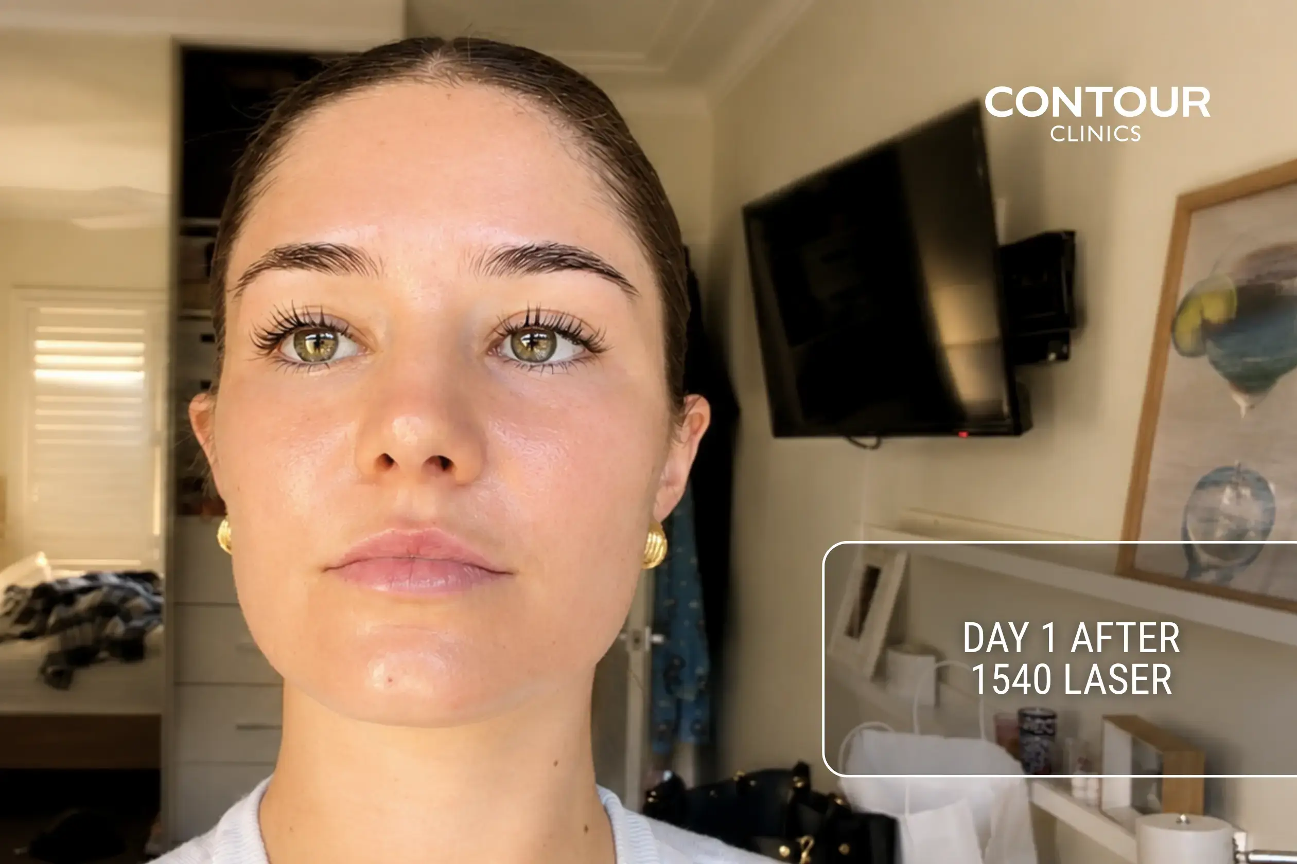 How skin looks 1 day after 1540 fractional laser