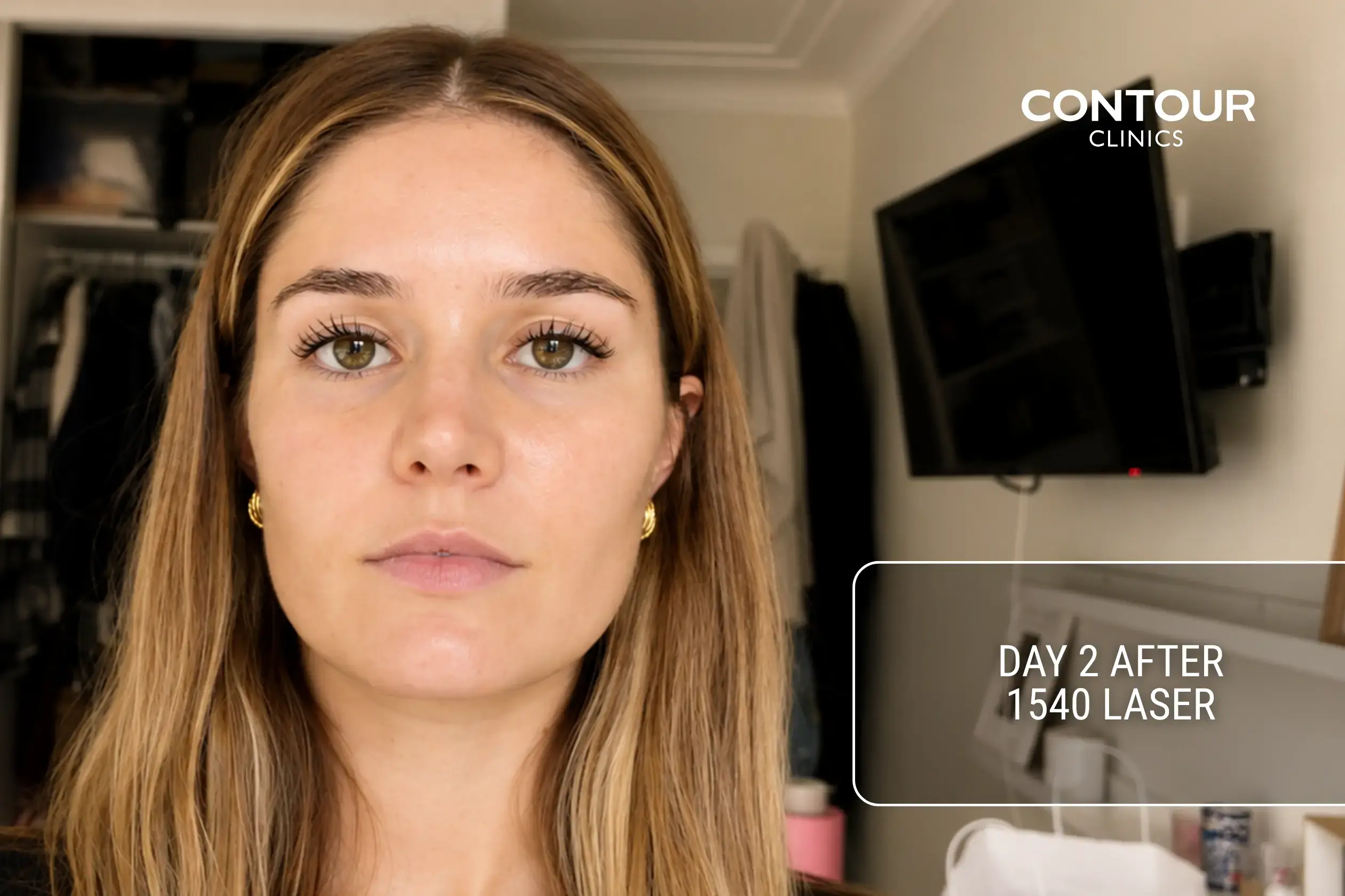 How skin looks 2 days after 1540 fractional laser.webp