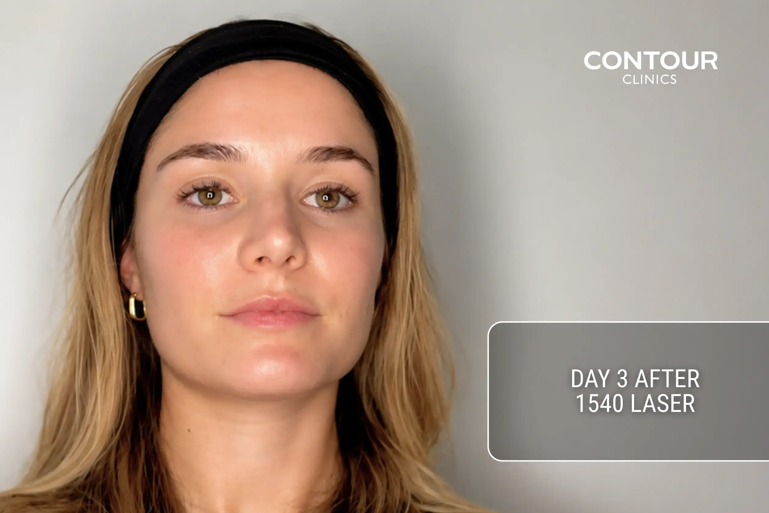 How skin looks 3 days after 1540 fractional laser.